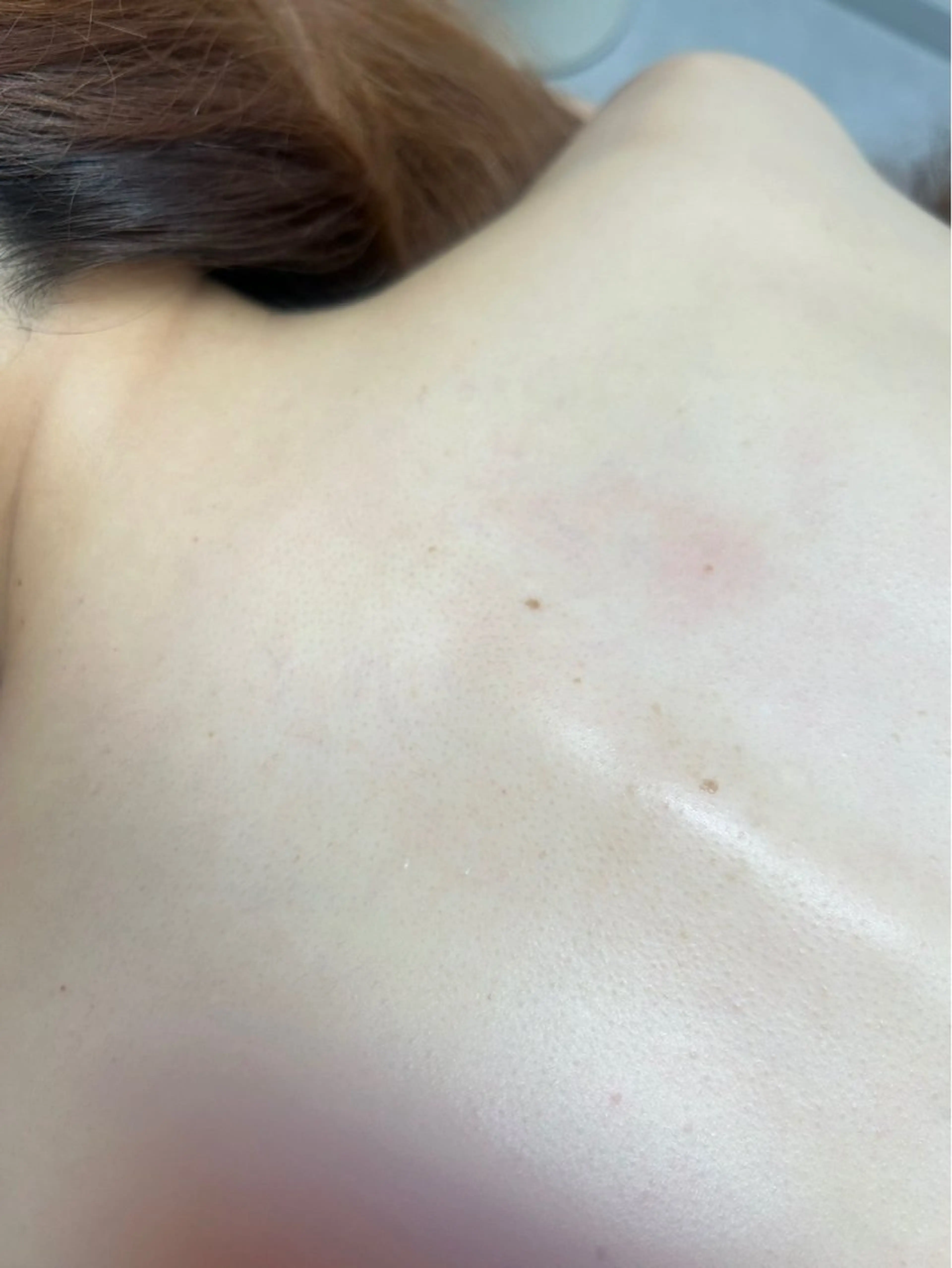 ワックス脱毛【背中のみ】の写真