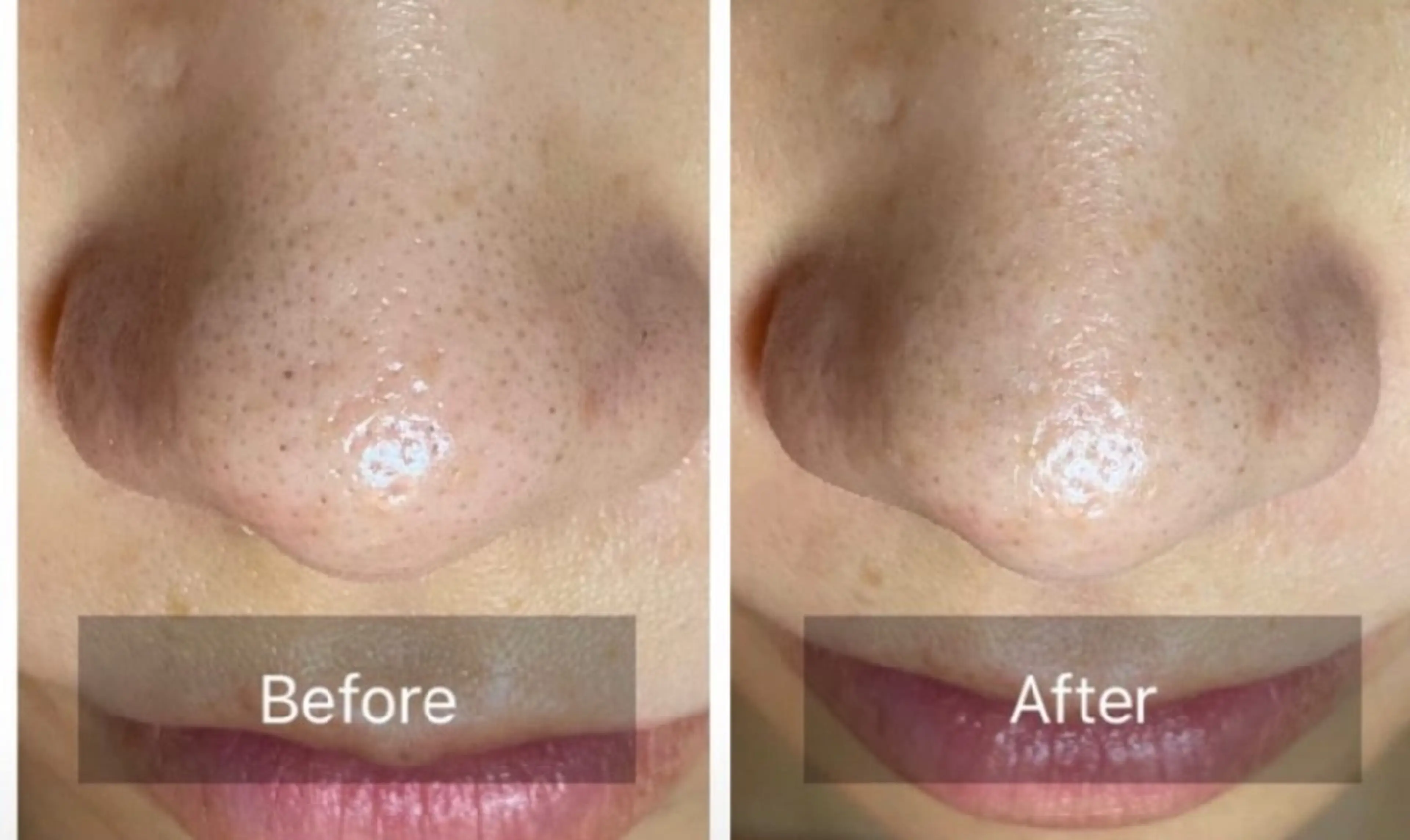 エイジングケアサロンBIOEL所属・肌質改善BIOELプ ラズマ/ラミピールのエステ・リラクイメージ