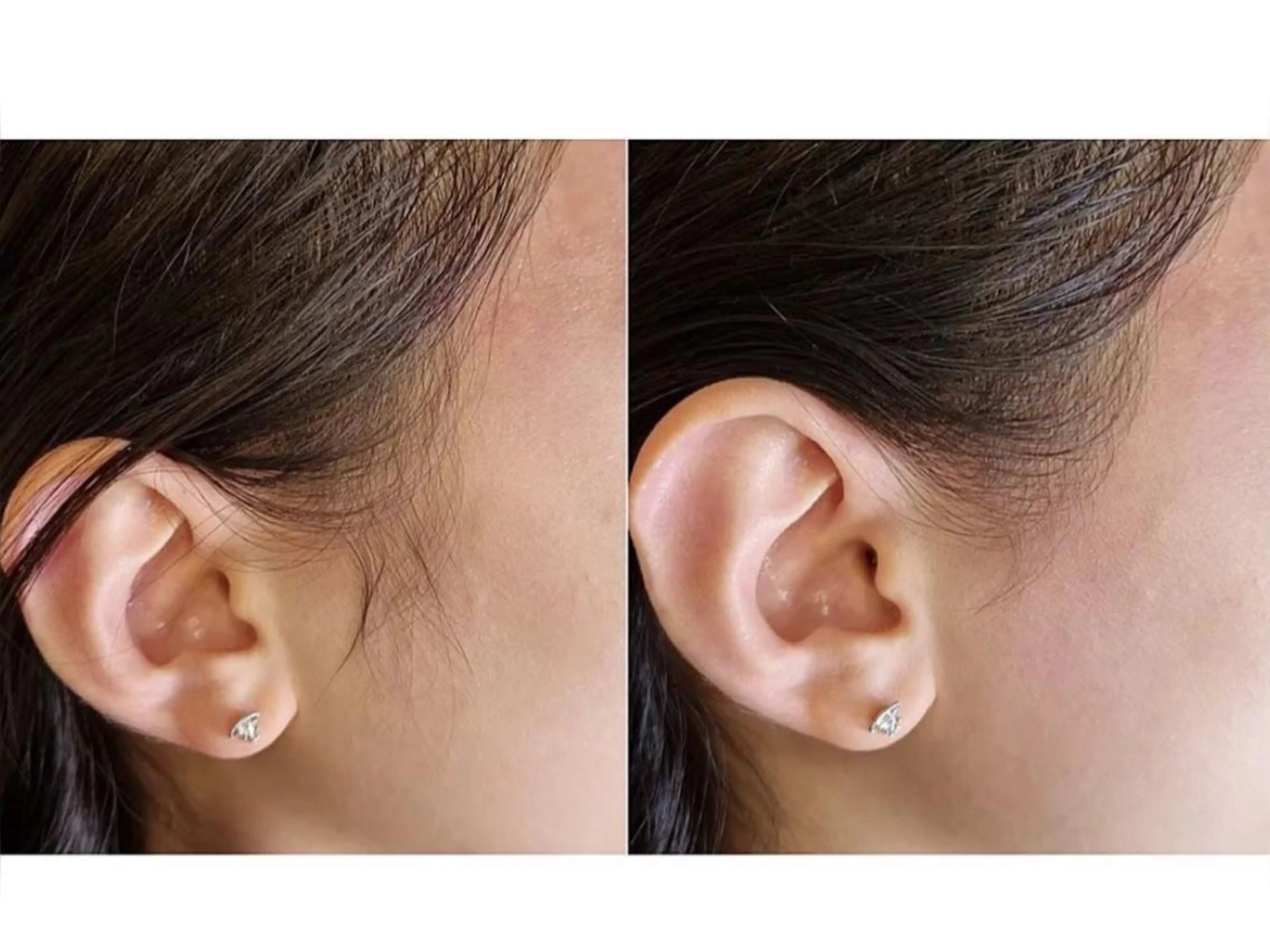 もみあげの写真