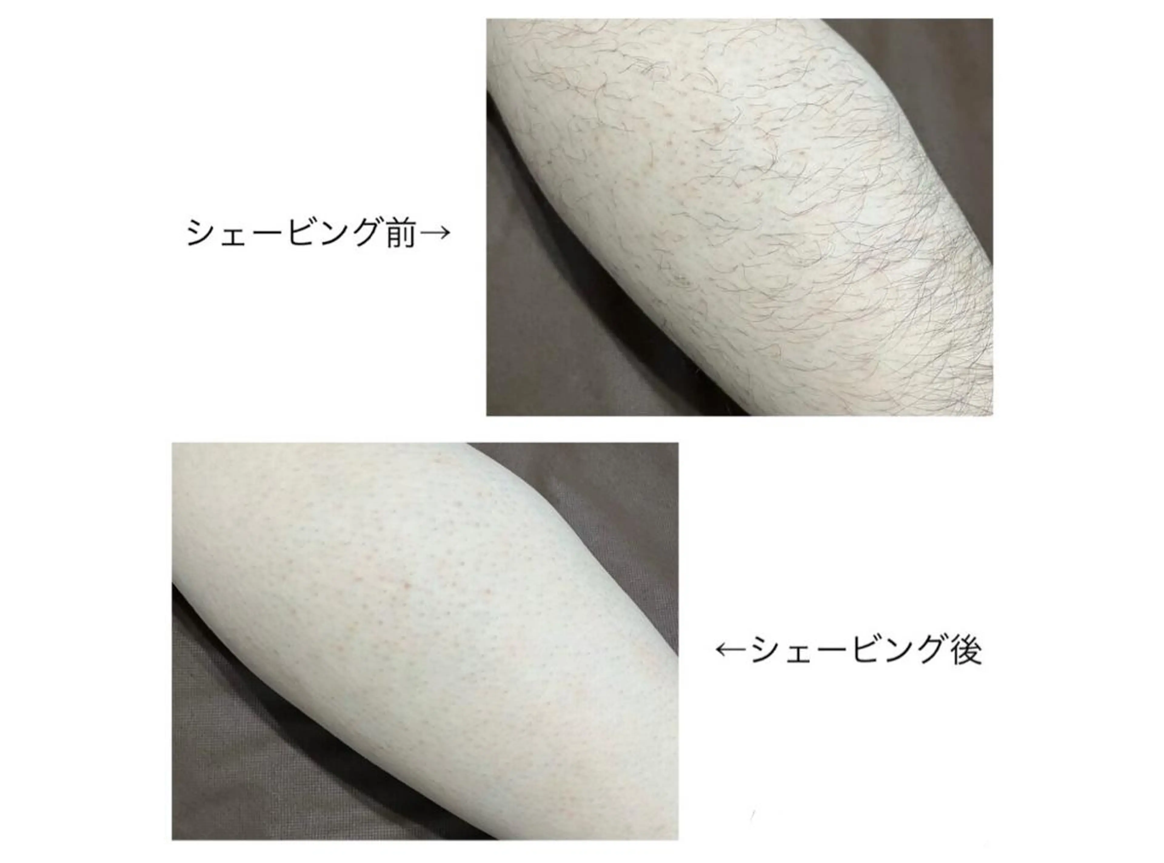 【メンズ】まずはお試し♪脚脱毛×3回¥30,000→¥9,980の写真