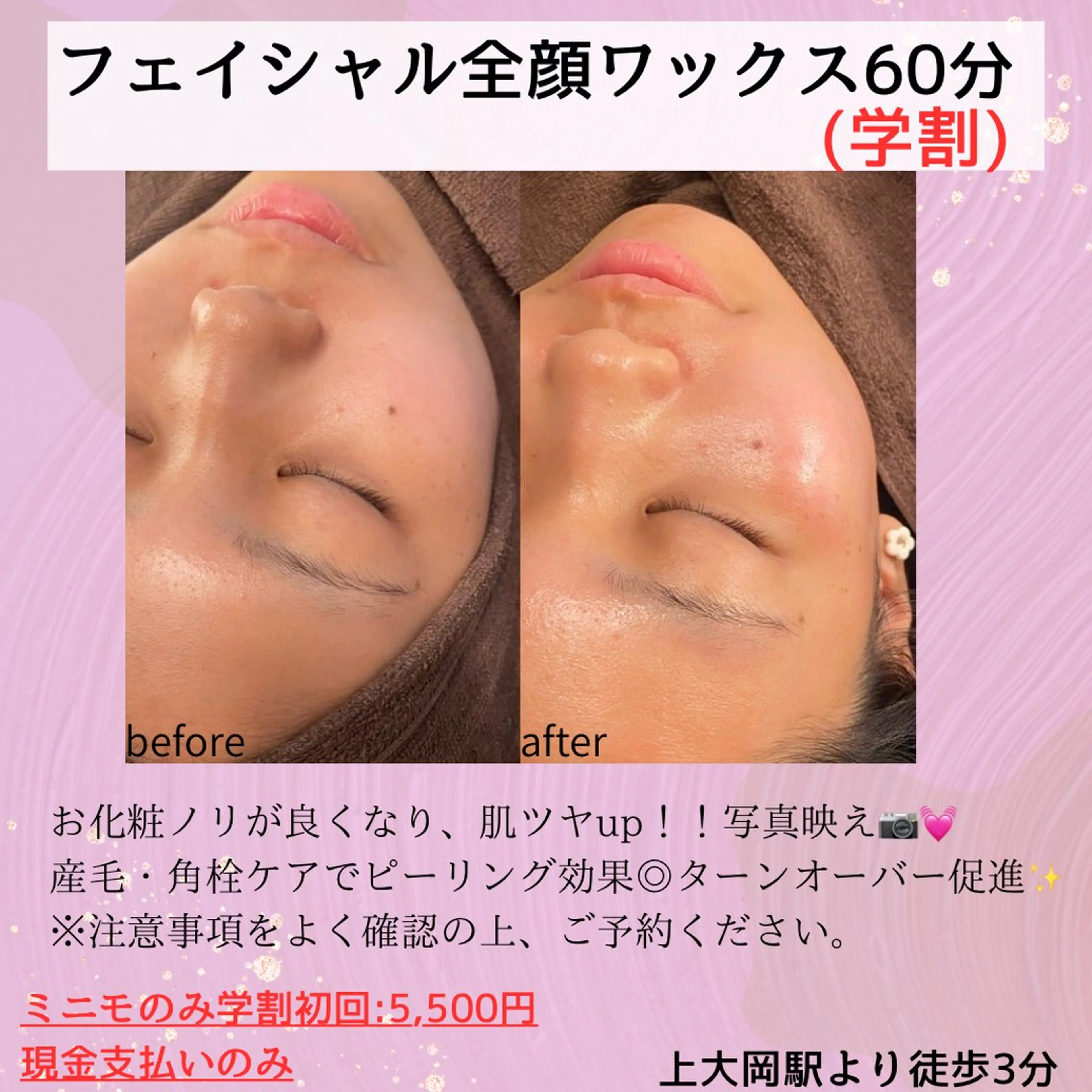 ミニモ学割🌸フェイシャル全顔ワックス✨産毛や角質ケアができピーリング効果◎お化粧ノリ・ツヤupで写真映え💖の写真