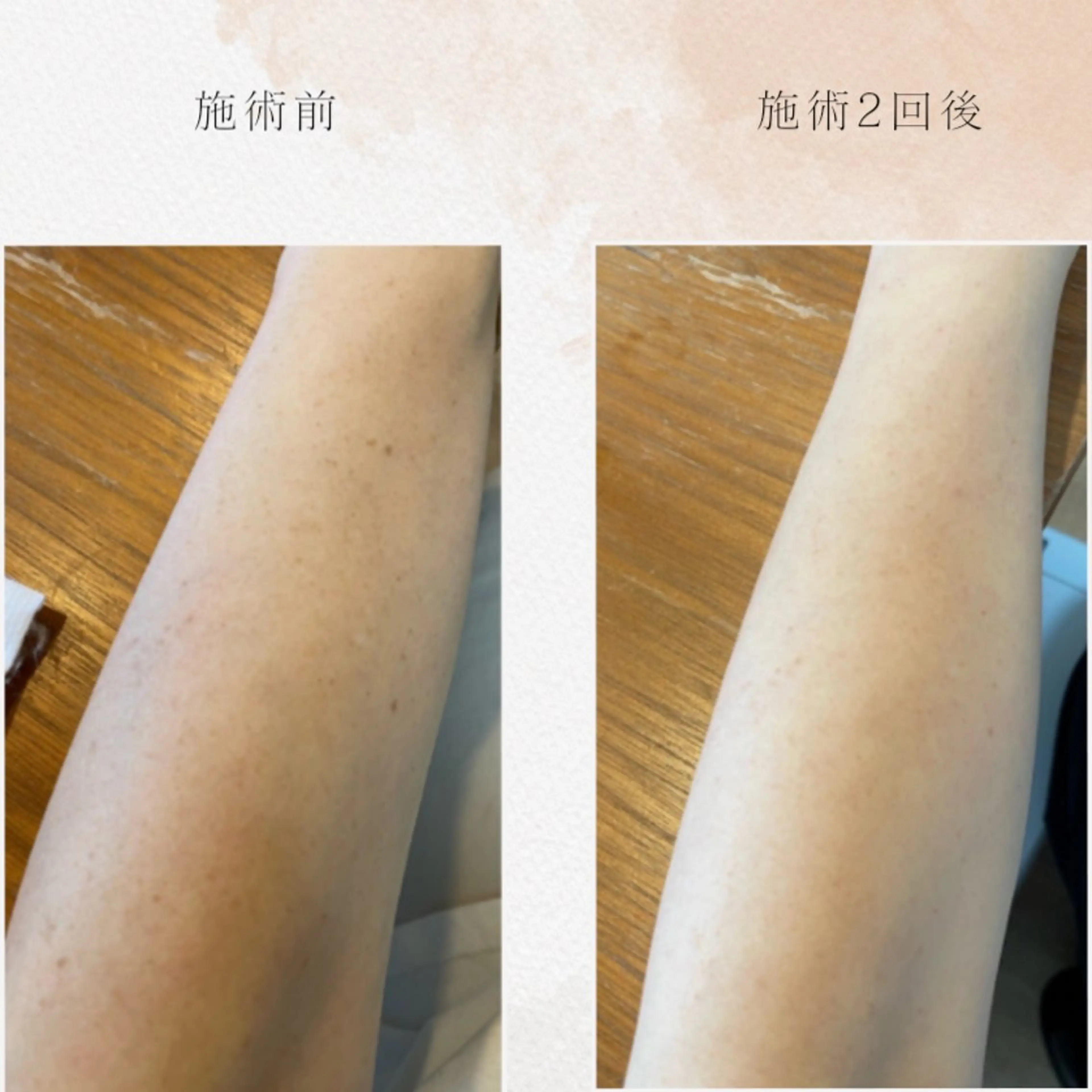 【10月末まで限定🌷】ボディ[二の腕][デコルテ]シミケア15分あて放題の写真