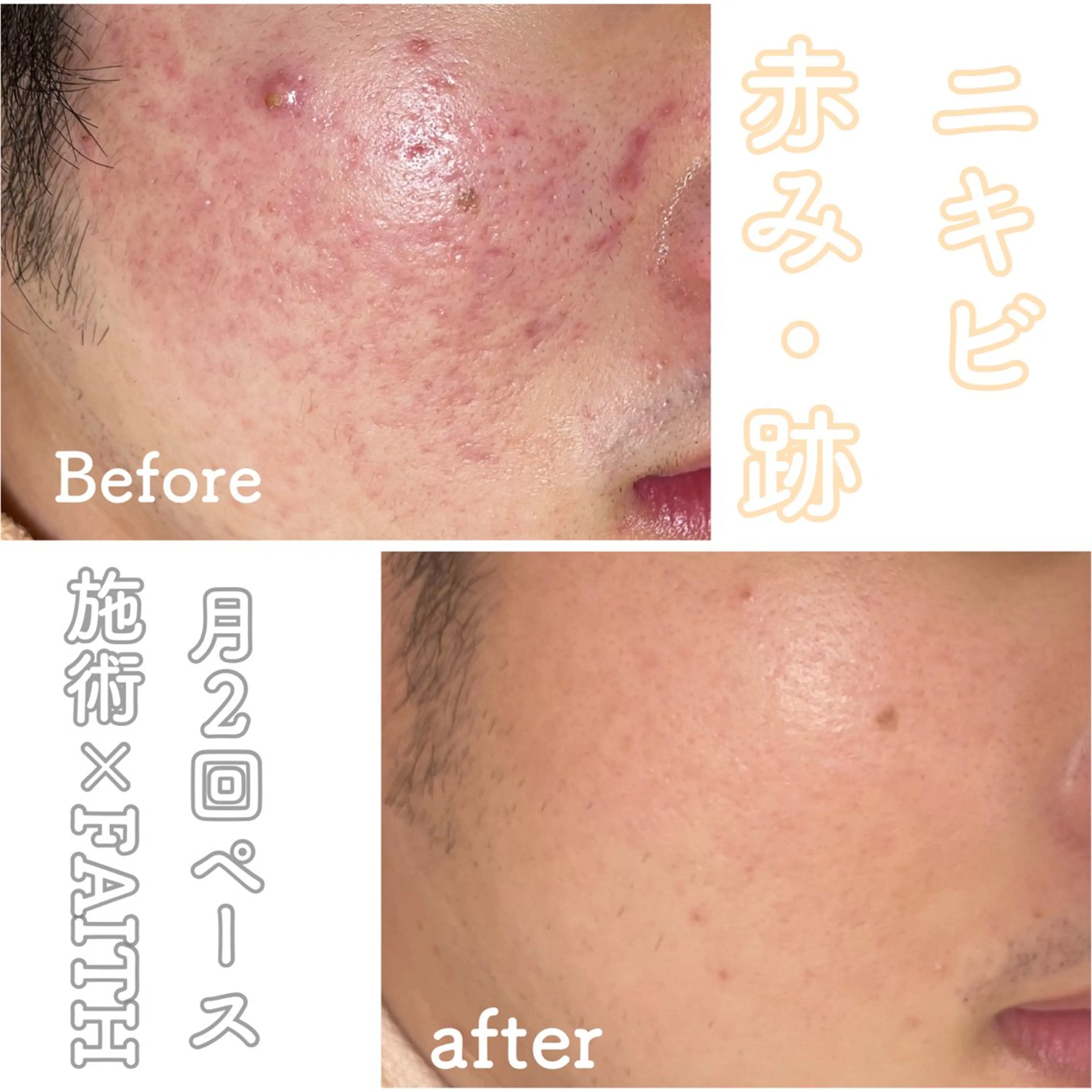 エステ ニキビ&跡改善サロン オーナー光木のエステ・リラクイメージ