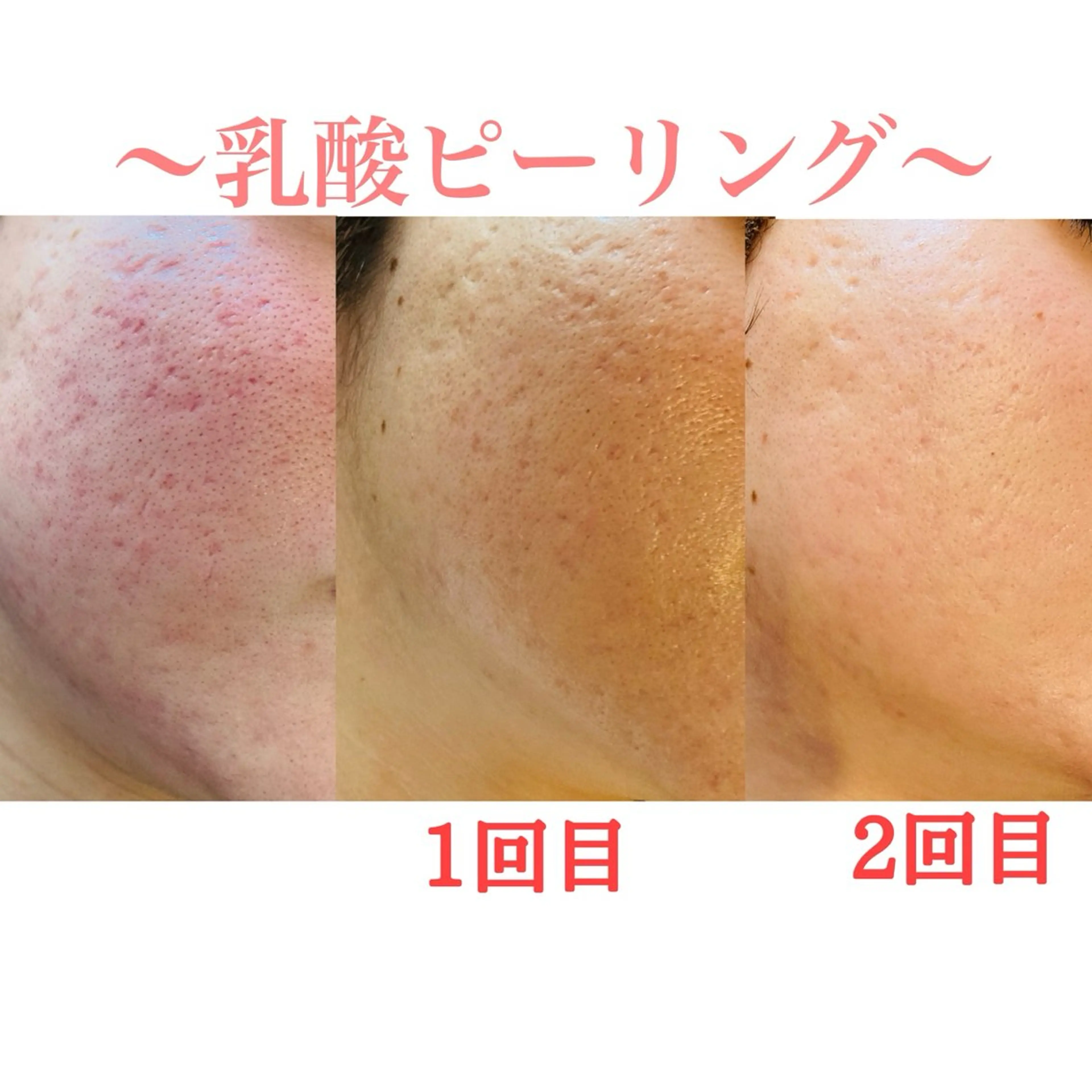【ニキビ/毛穴でお悩みの方へ】ニキビケア＆艶肌に◎乳酸ピーリング（お肌タイプ別生コラーゲンマスクでコラーゲンチャージ！）の写真