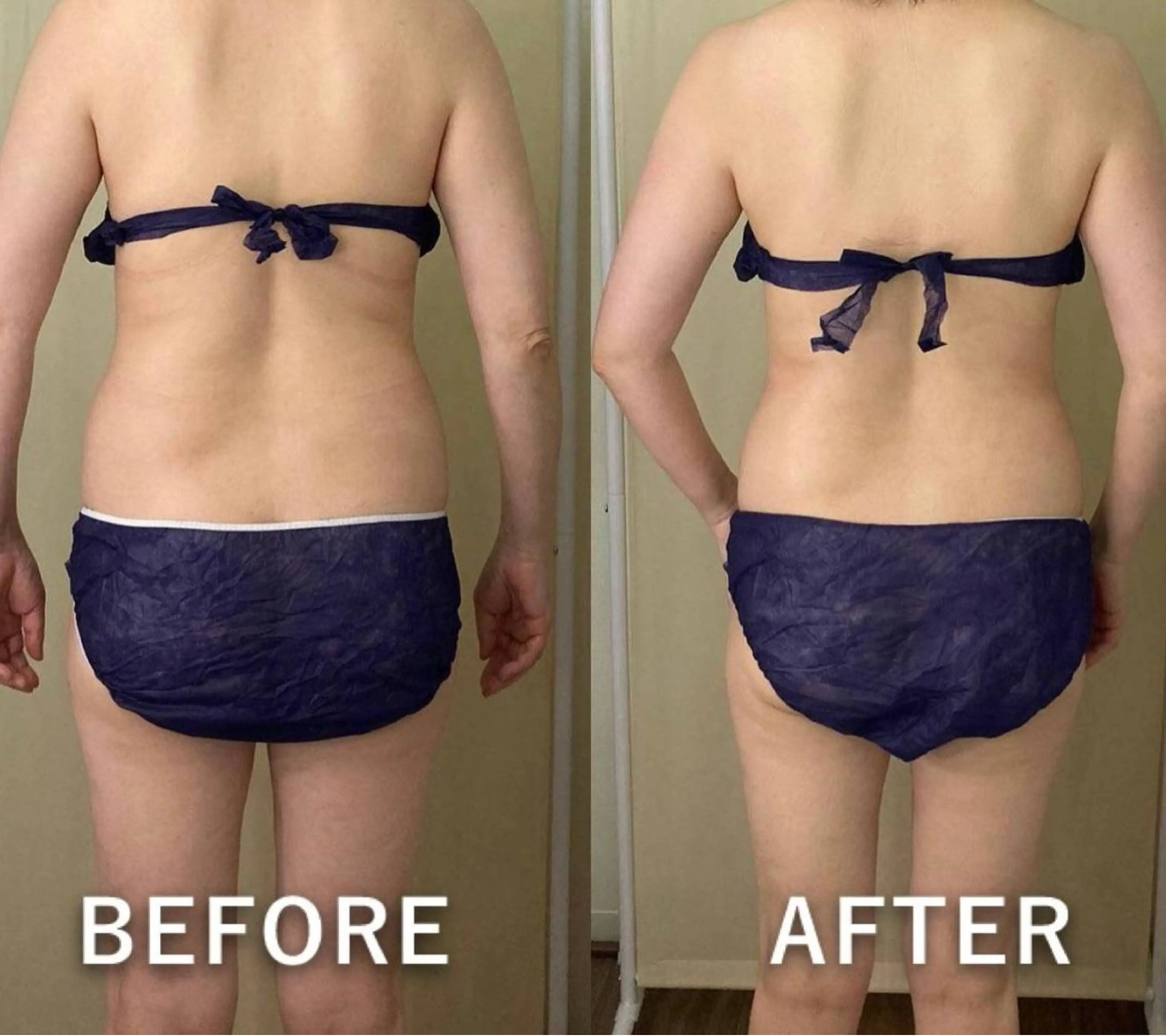 痩身◆【背中/二の腕コース】キャビ＋ラジオ派＋痩身マッサージ 55分 5500円→の写真