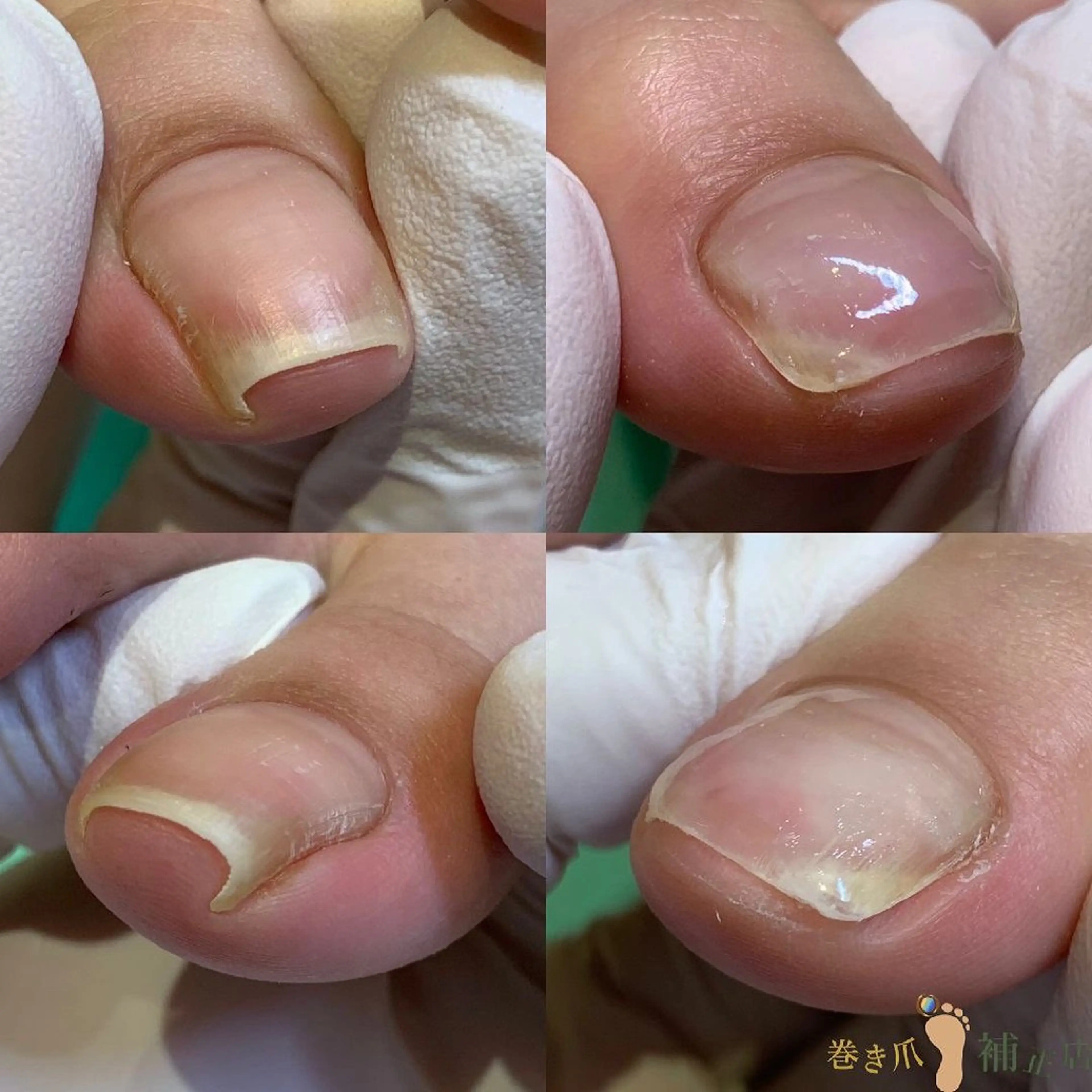 巻き爪補正店　柏店所属・巻き爪補正店 柏店のその他イメージ