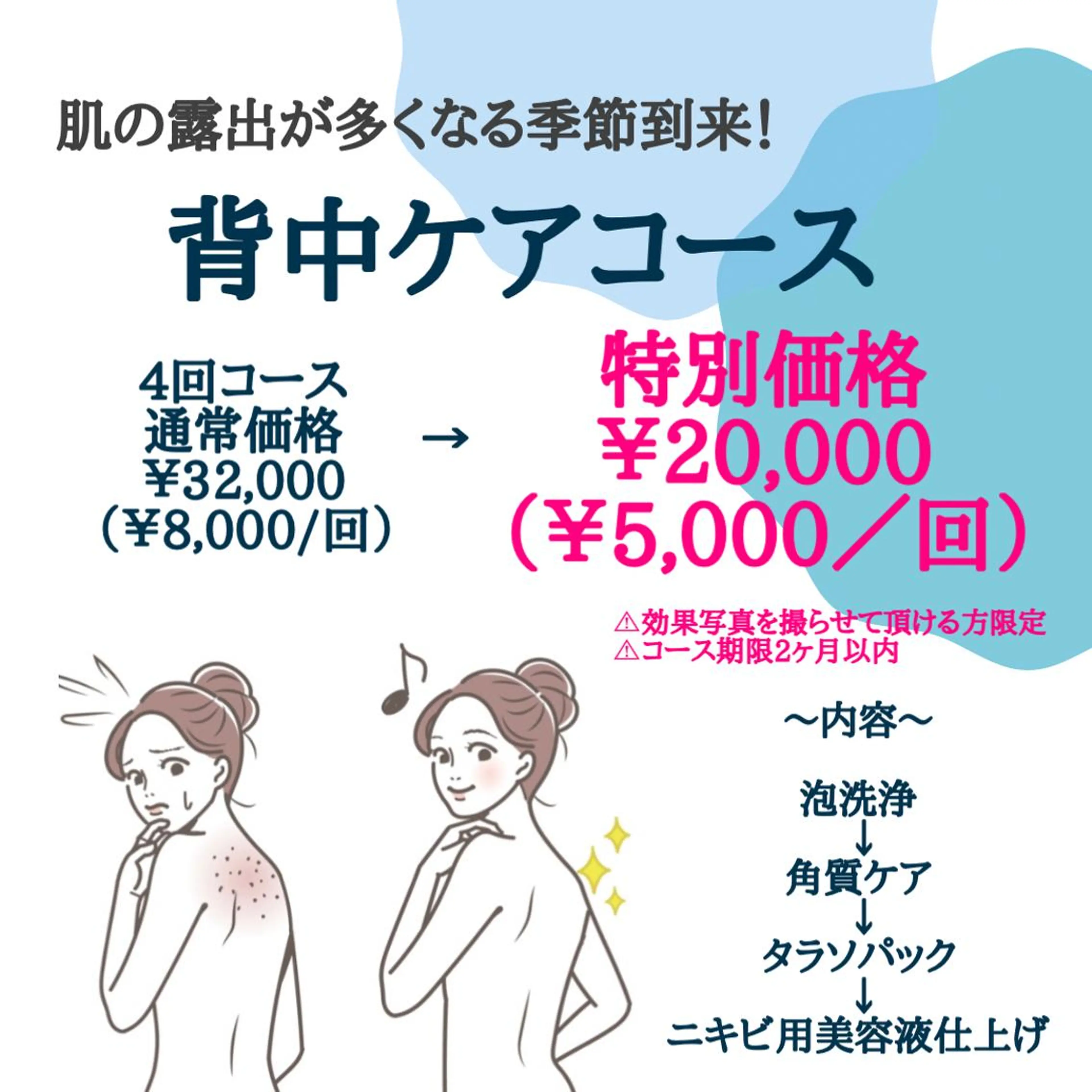 肌を見せる時期到来♪4回集中背中ケアコース＊花嫁さんにも/背中ニキビの写真