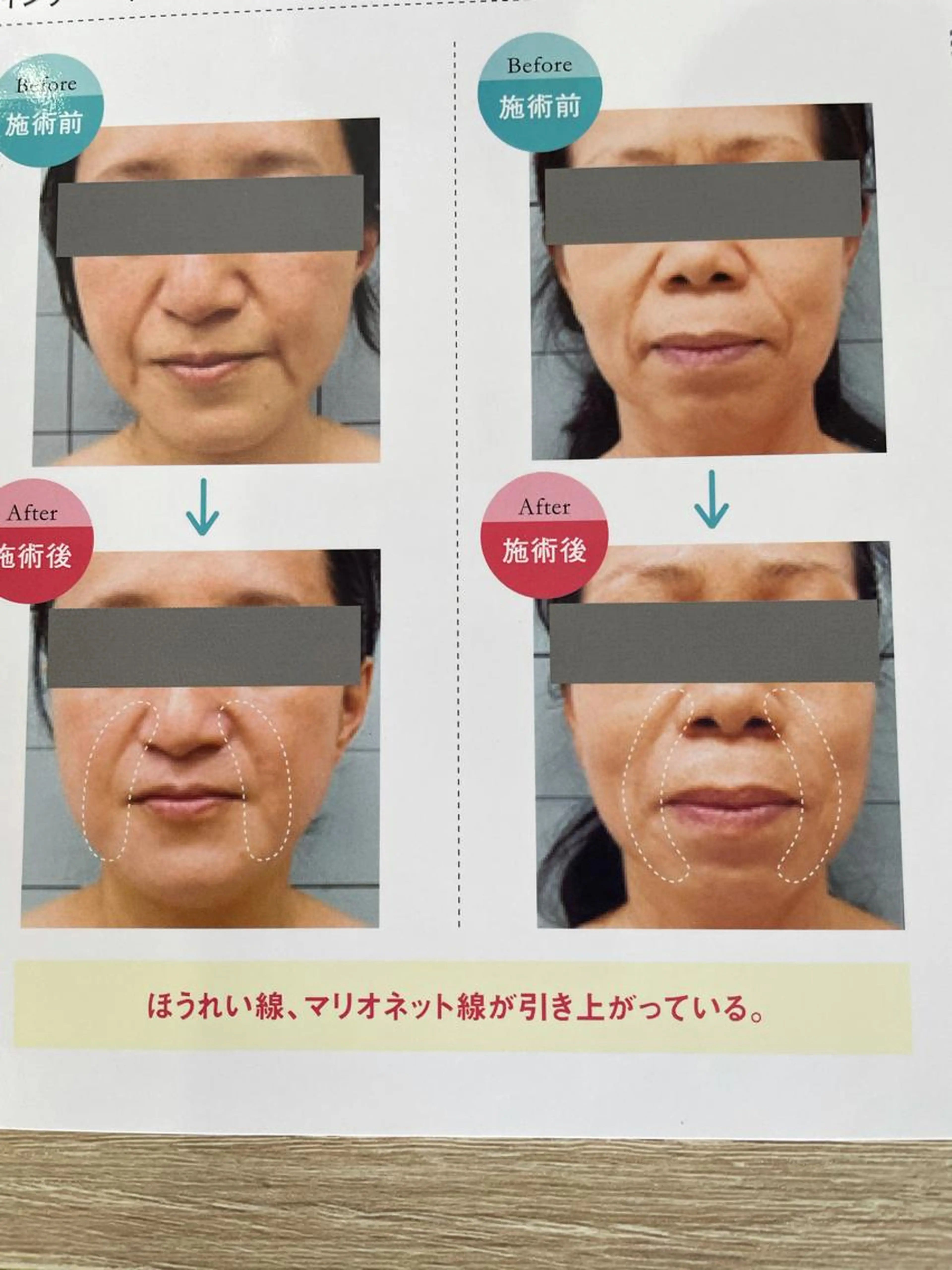 インナーマッスルトリートメントの写真