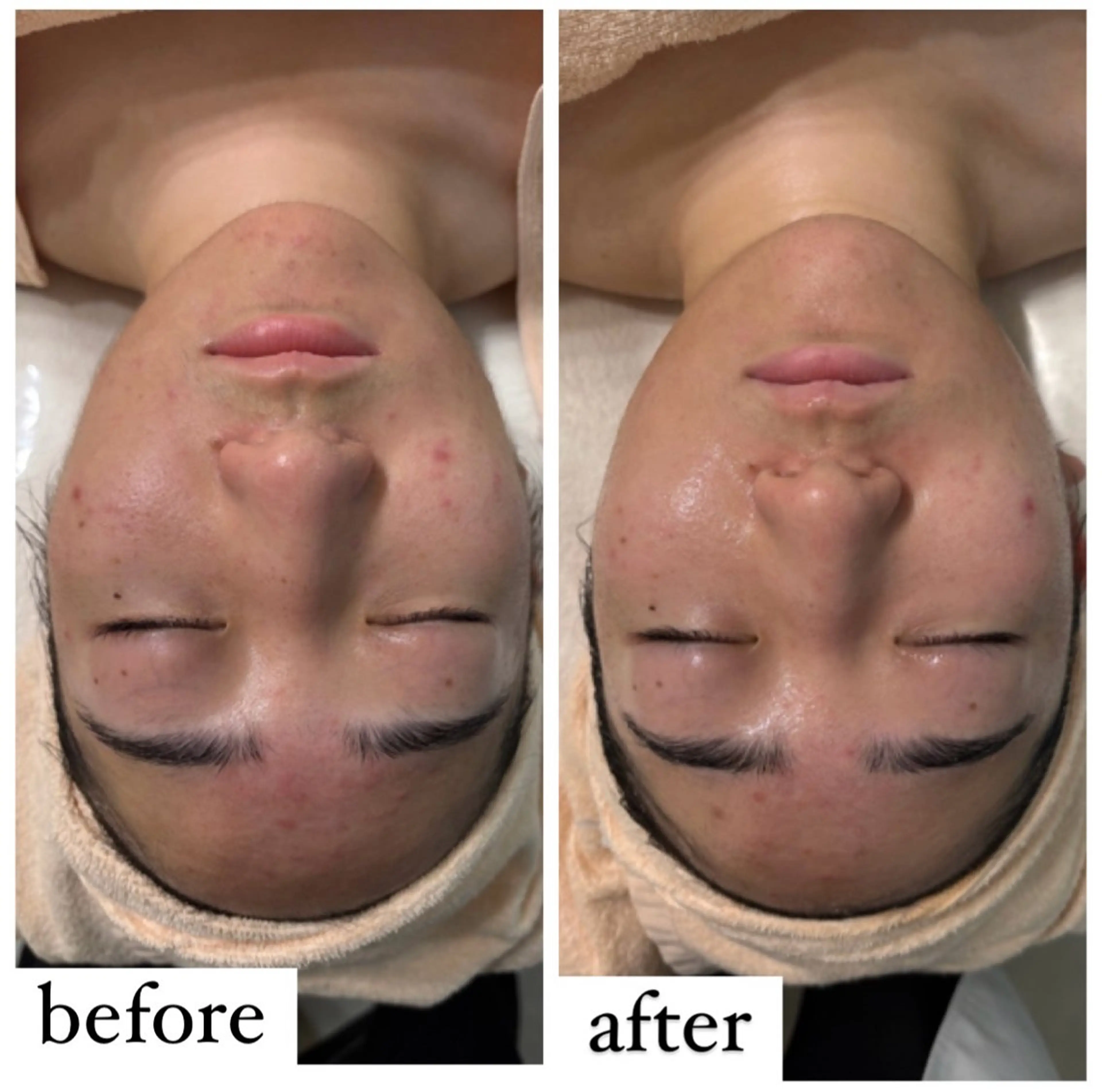 エステ 【ハーブピーリング】 Allumentのエステ・リラクイメージ