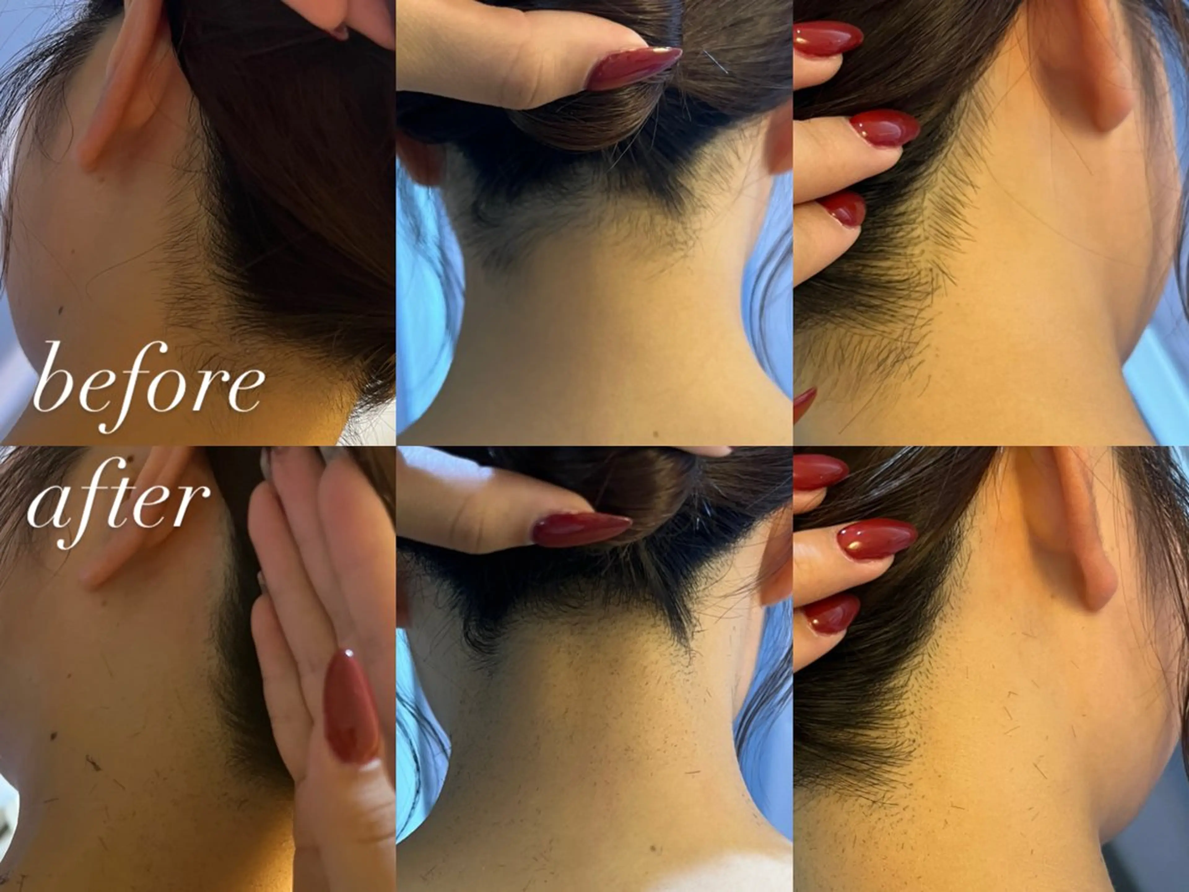 脱毛 うなじ脱毛/美肌脱毛 LABELのエステ・リラクイメージ