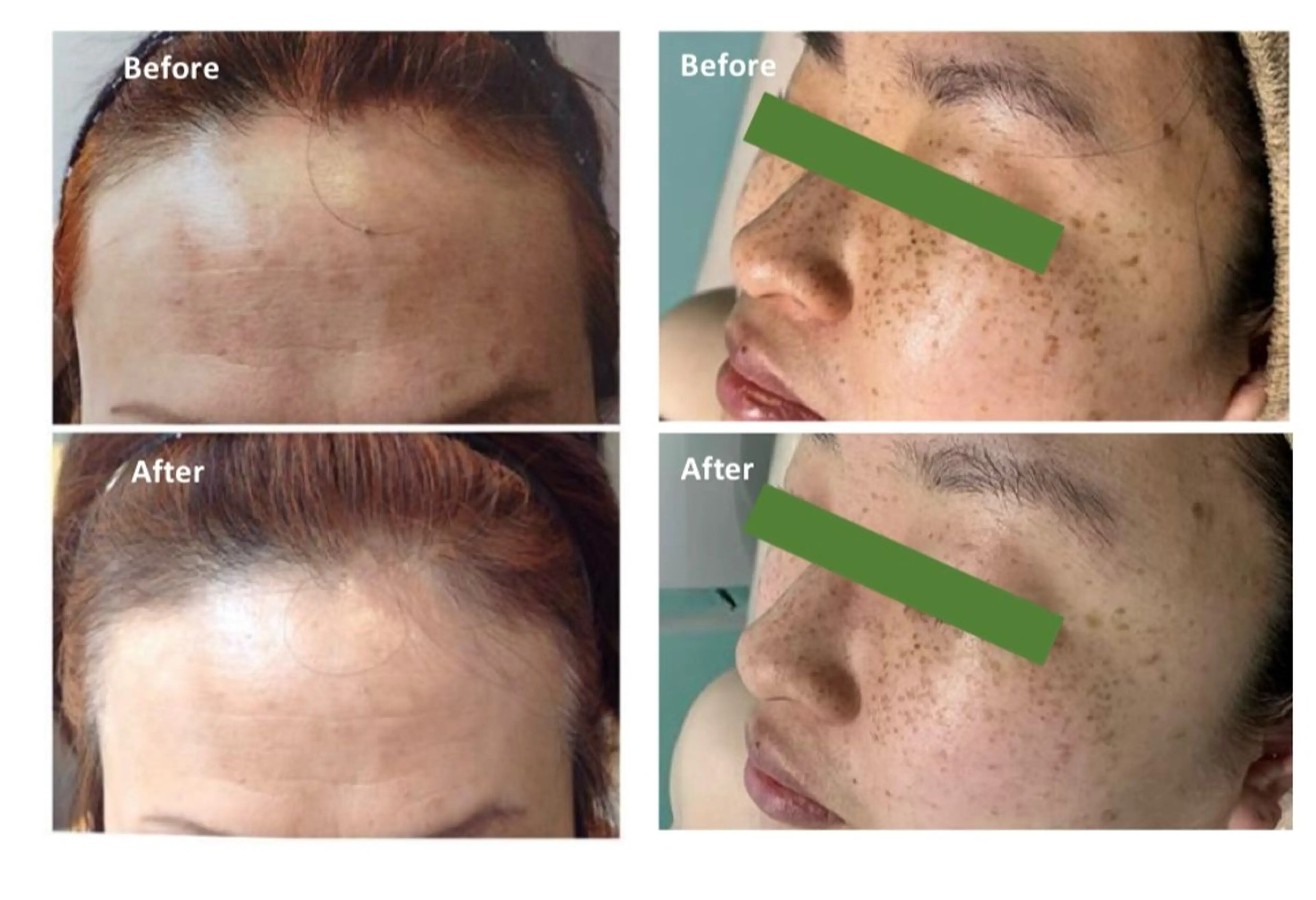 エステ ハーブピーリング ララピール術後ケアのその他イメージ