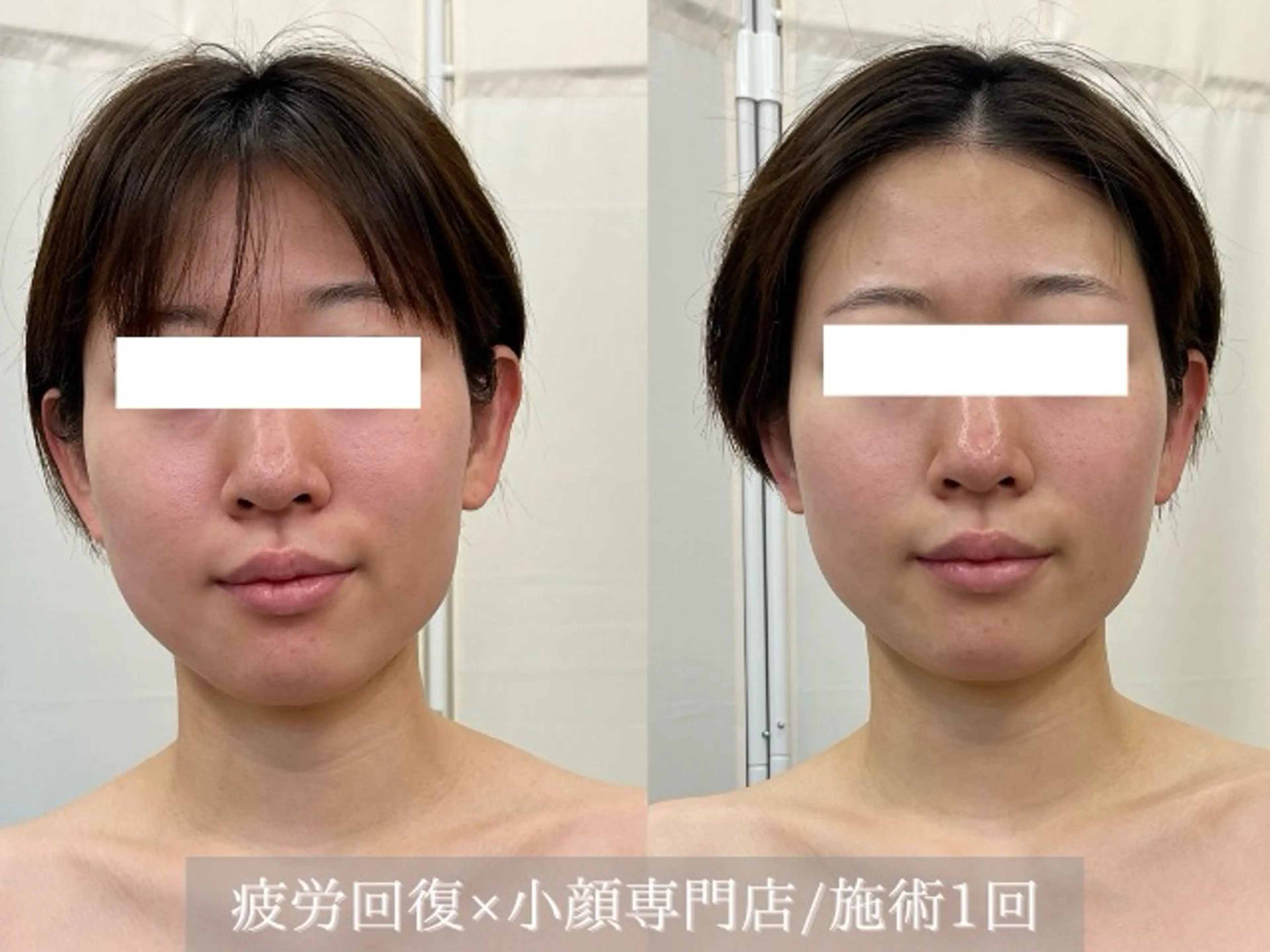 クイックコルギ＋顔脱毛(70分)の写真