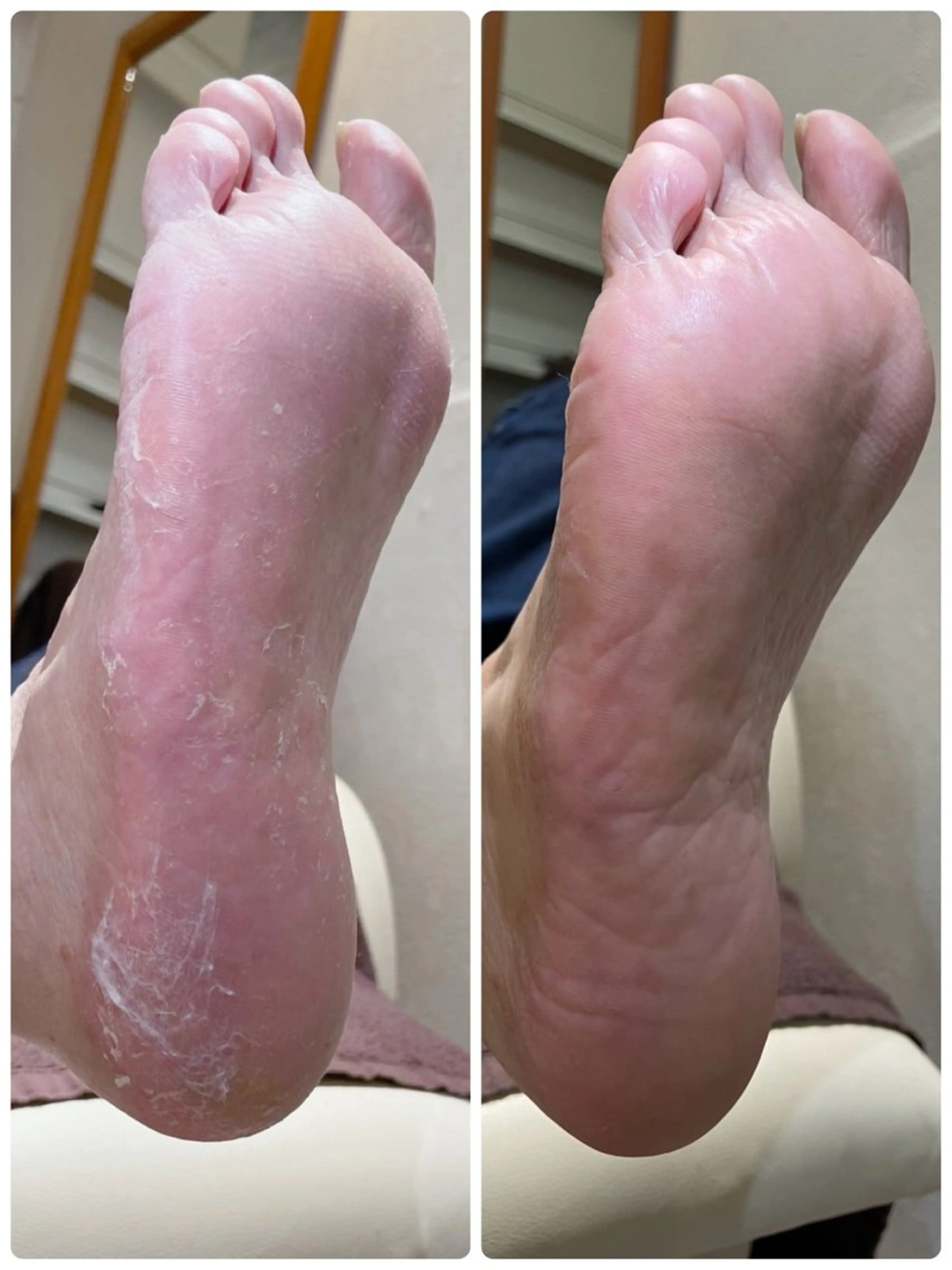 足裏角質除去の写真