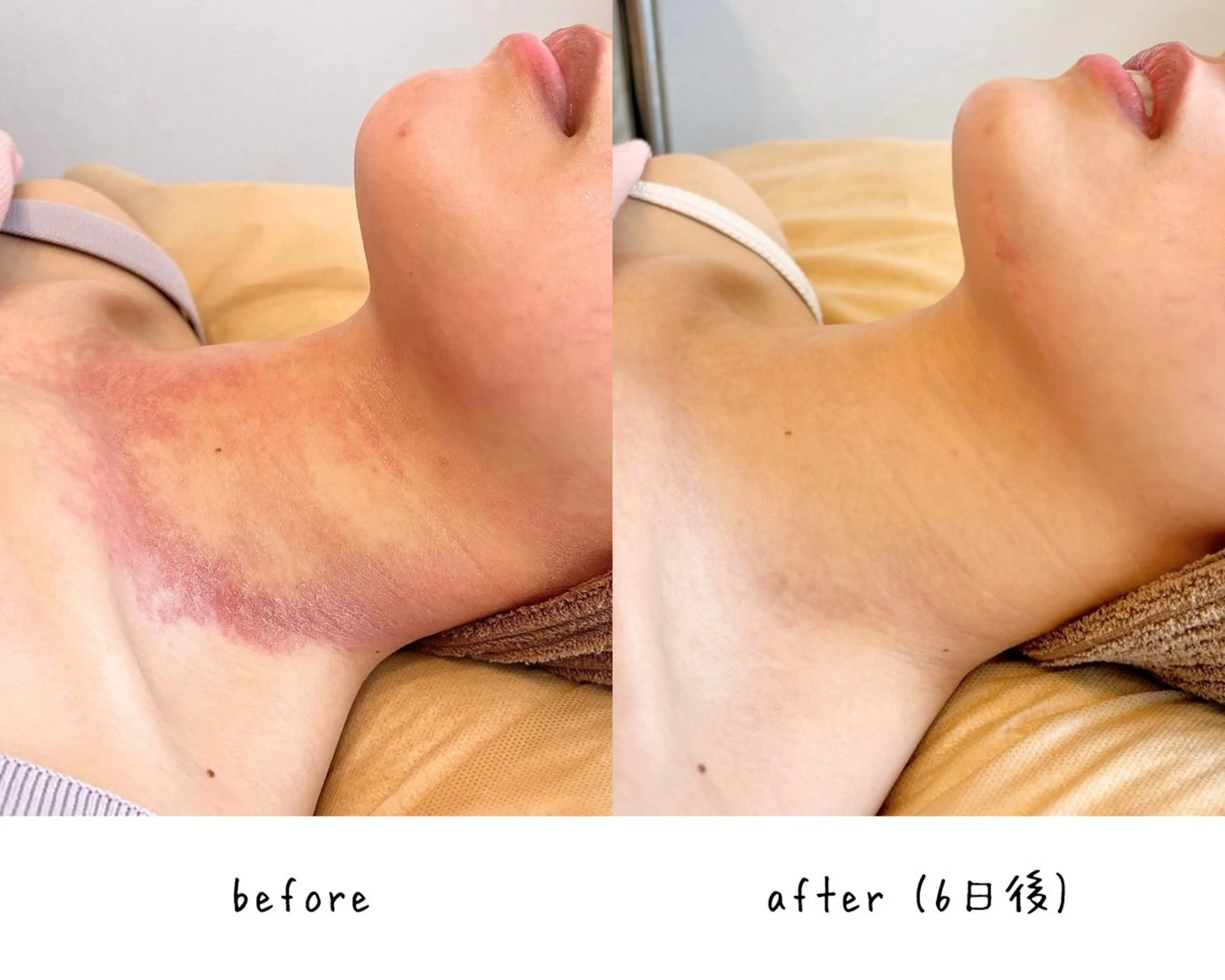 【グリーンピール5days】最高峰‼︎ホームケア用品付きの写真