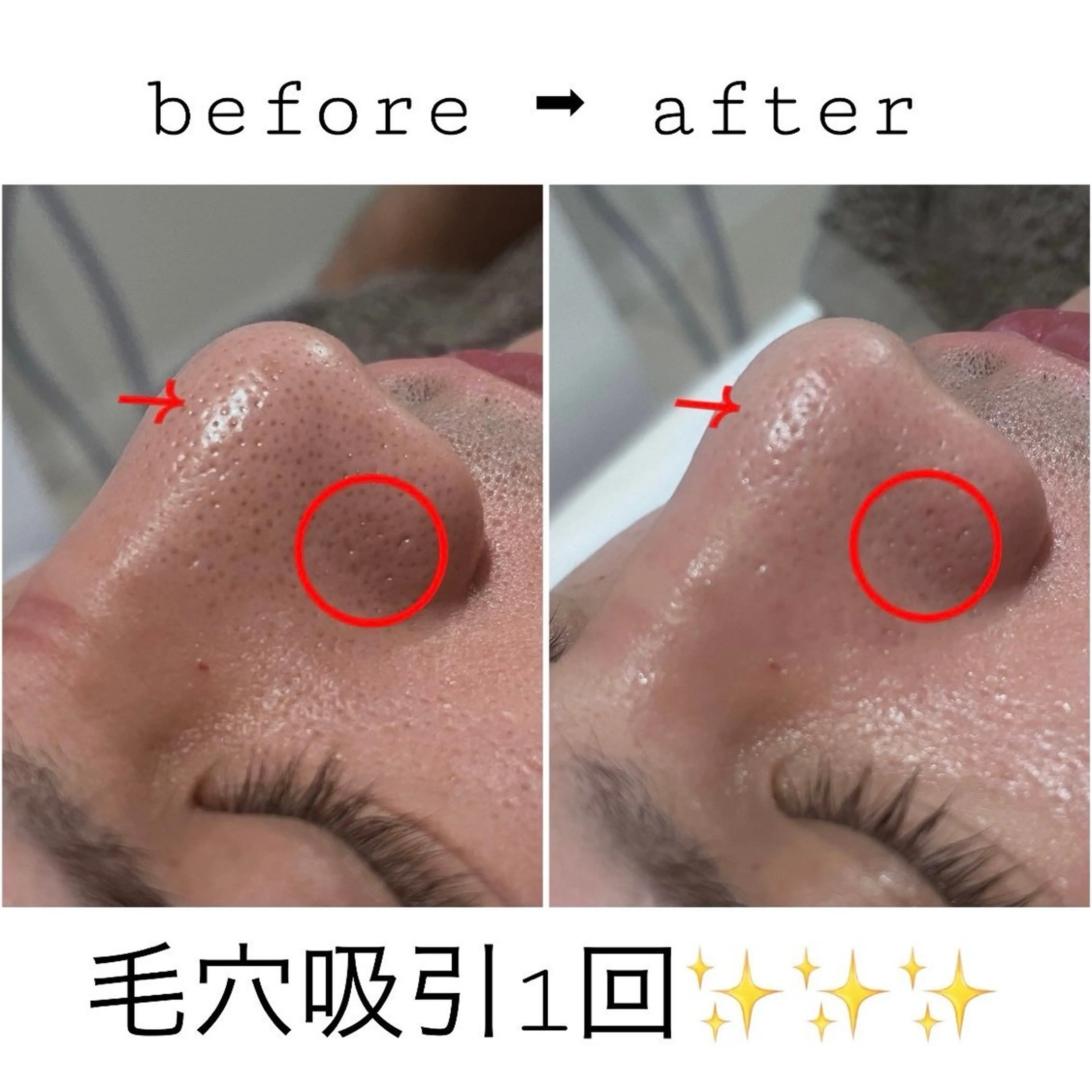 【破格🎶50%🈹ヘッド&デコルテマッサージ付】クイック改善💆♀️毛穴吸引×泡パック🫧オフ美容フェイシャル50分の写真