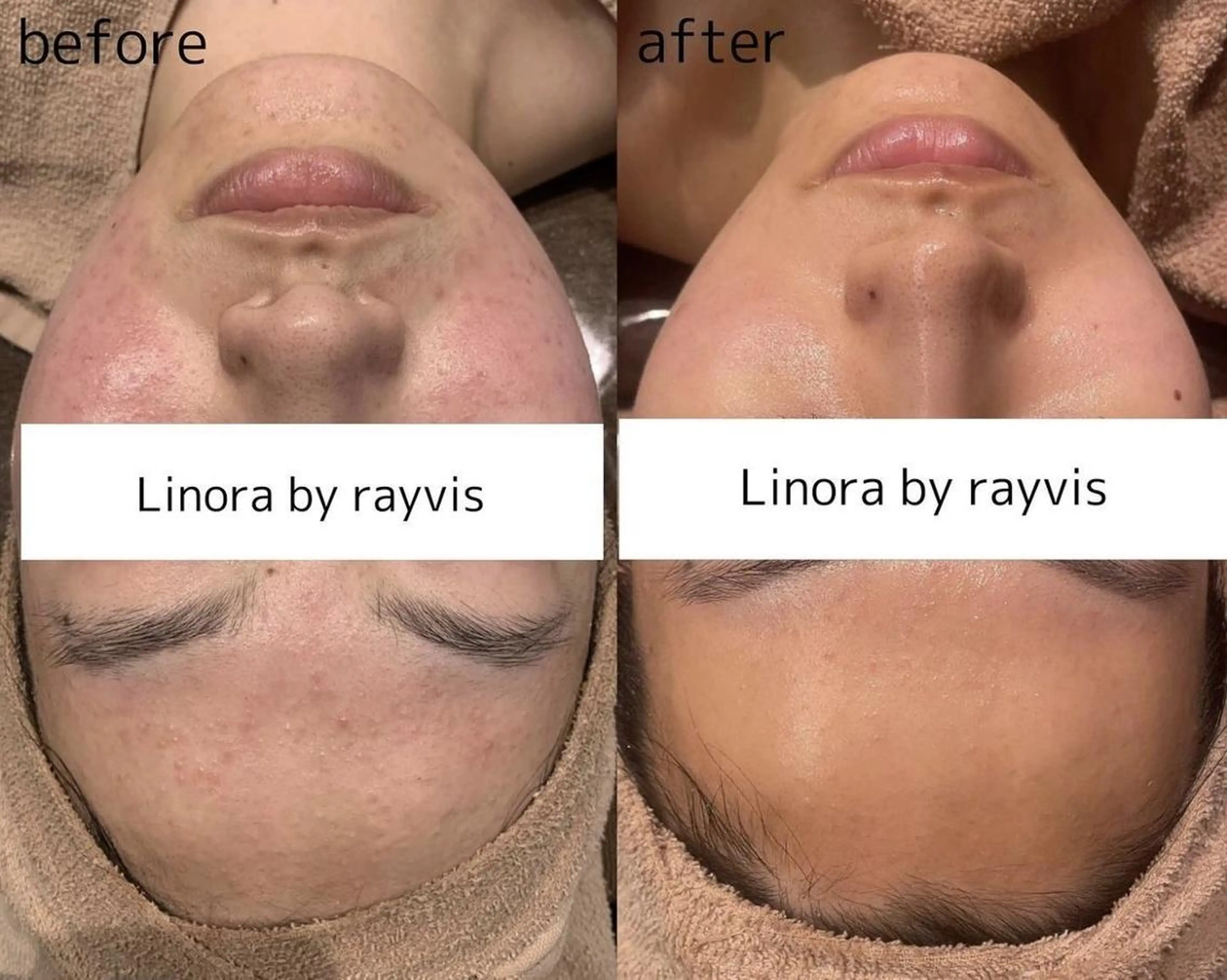 当店人気メニュー🌈【🌿剥離ありハーブピーリング🌿】早く治したい炎症ニキビに💦即効性重視な方向け🌟本格肌質改善❗の写真