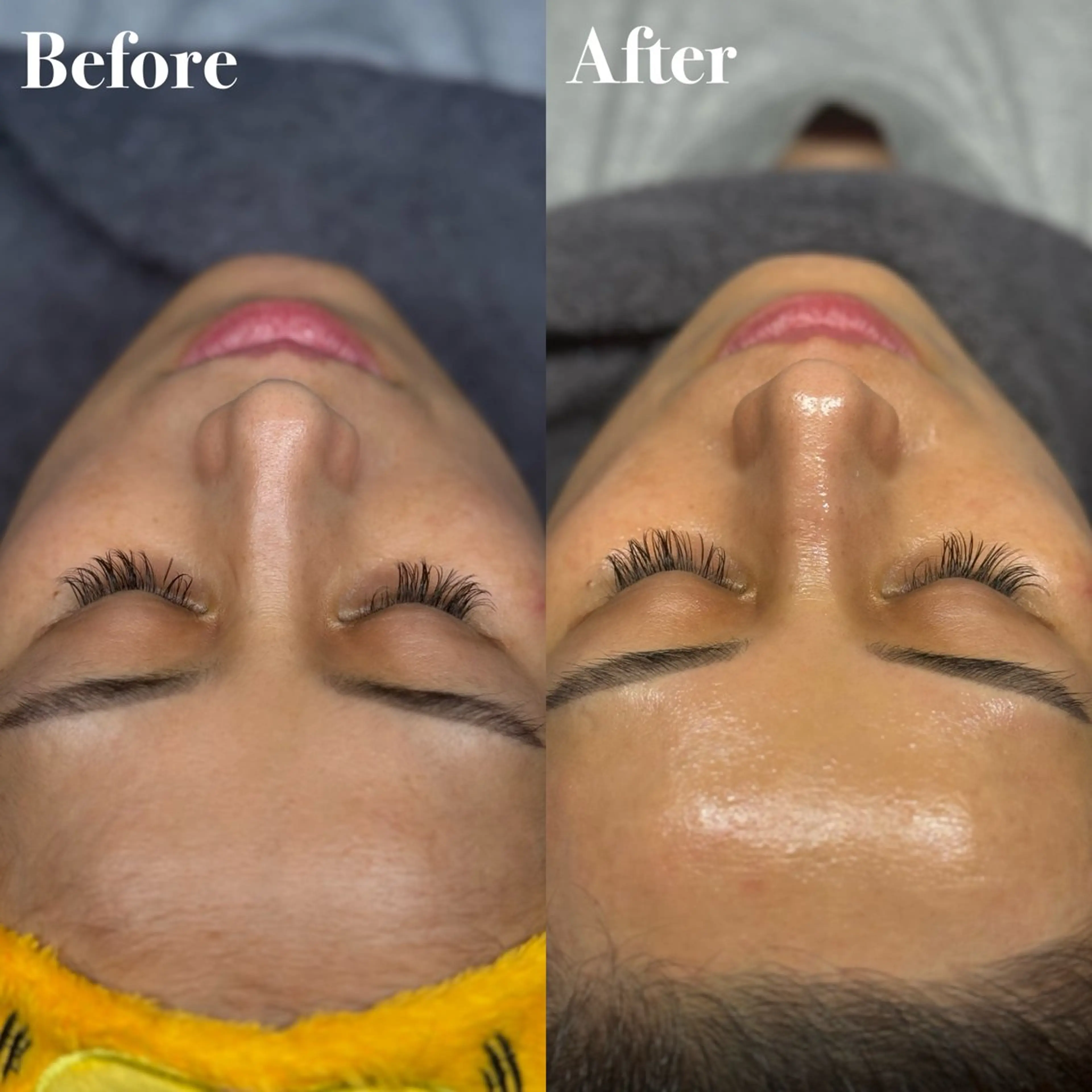 マリムーブフェイシャルwax脱毛の写真