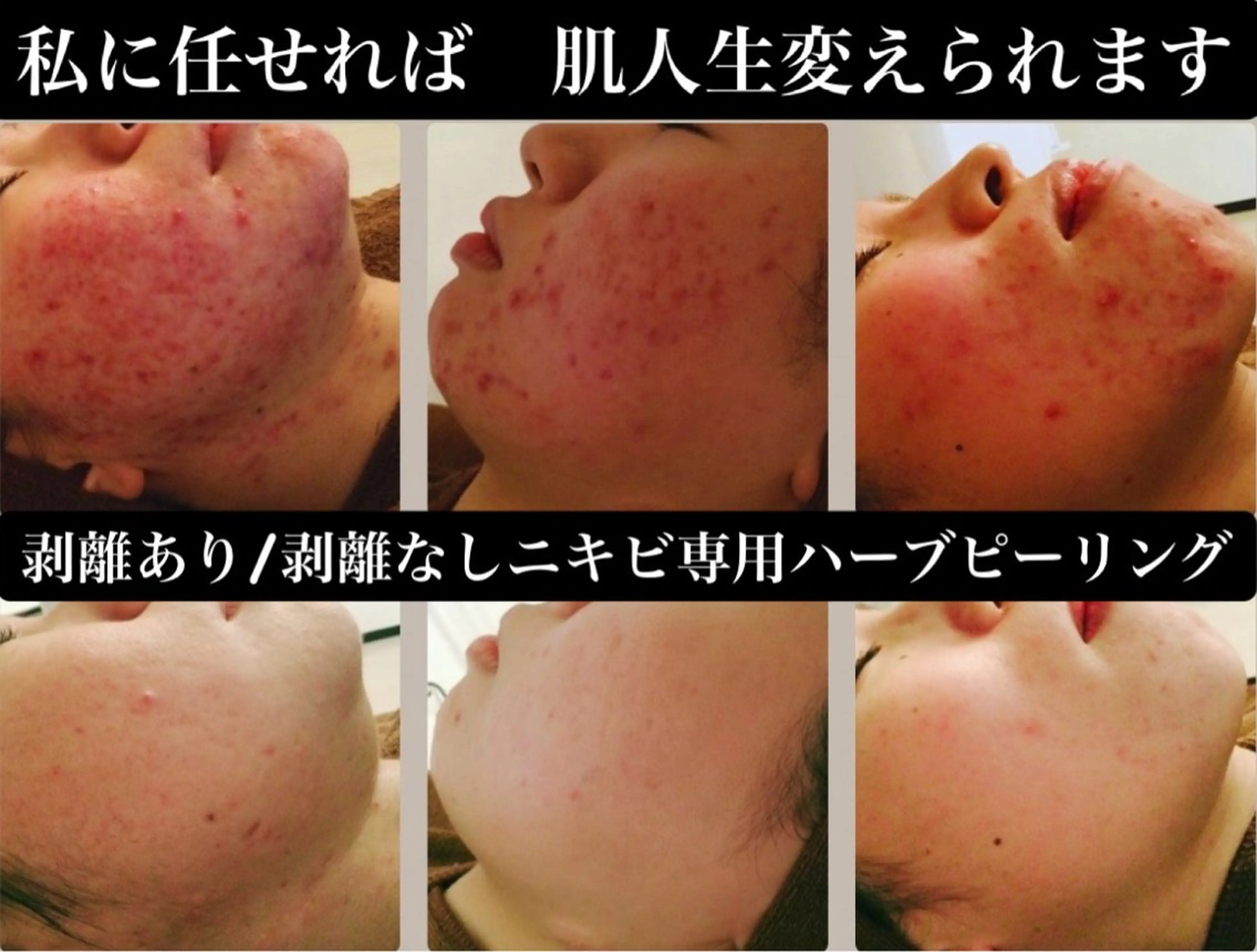 ニキビ/肌質改善専門 Snow skinのエステ・リラクイメージ