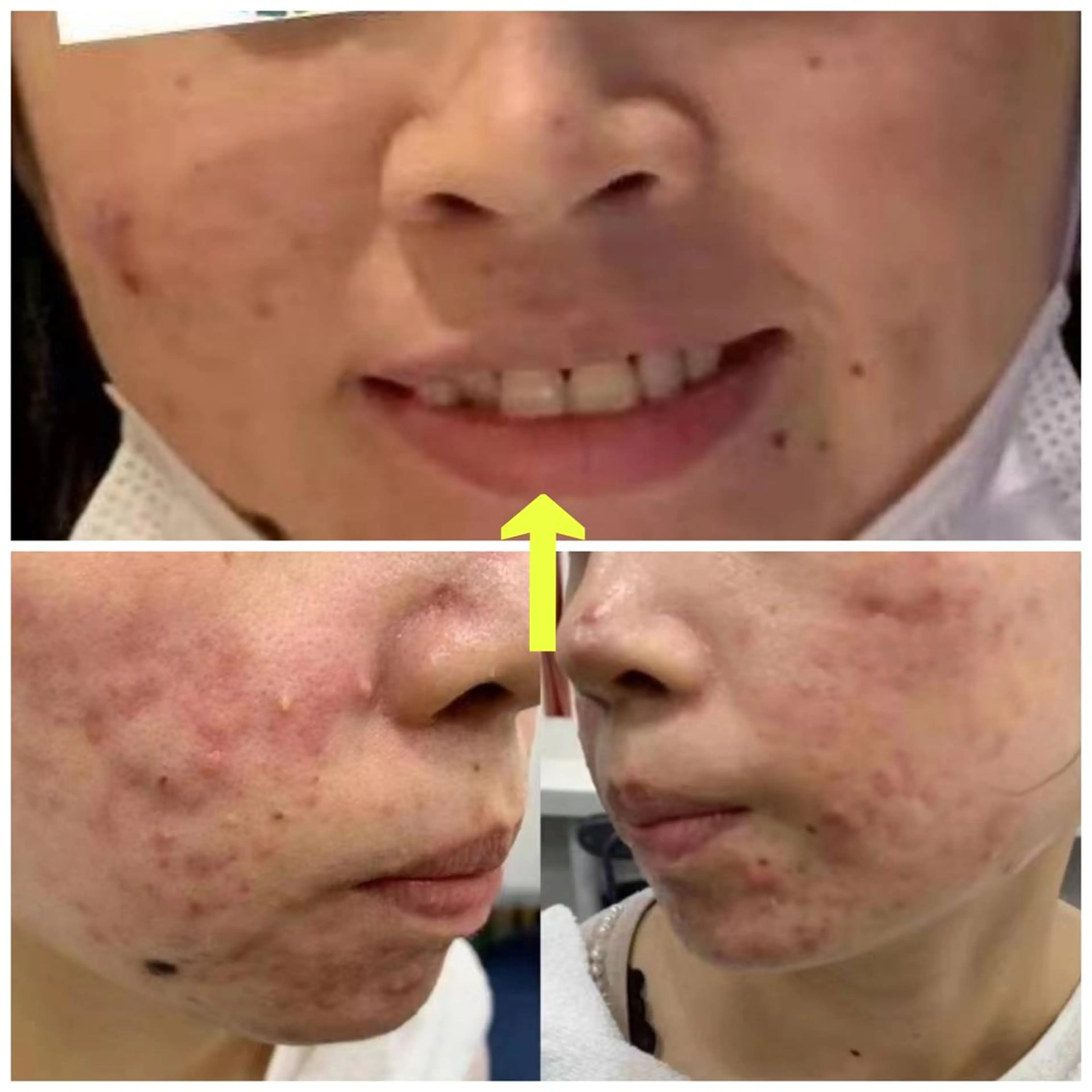 ニキビ，ニキビ跡が気になる方におすすめ　黄土よもぎ蒸し40分＋ハーブピーリング🌿で美肌ケアの写真