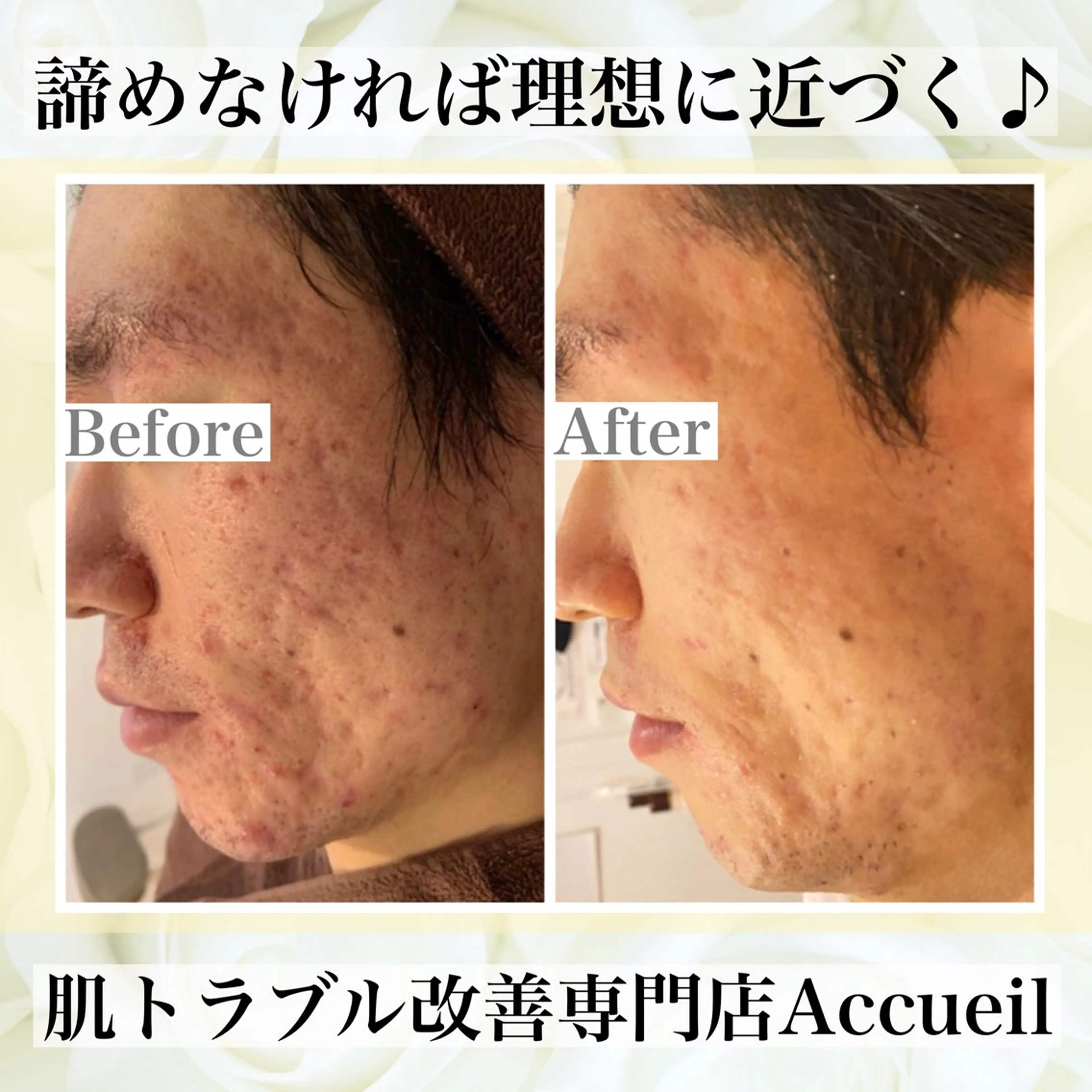 エステ リラク ニキビ・肌質改善専門 ♡人生が変わるサロンのエステ・リラクイメージ