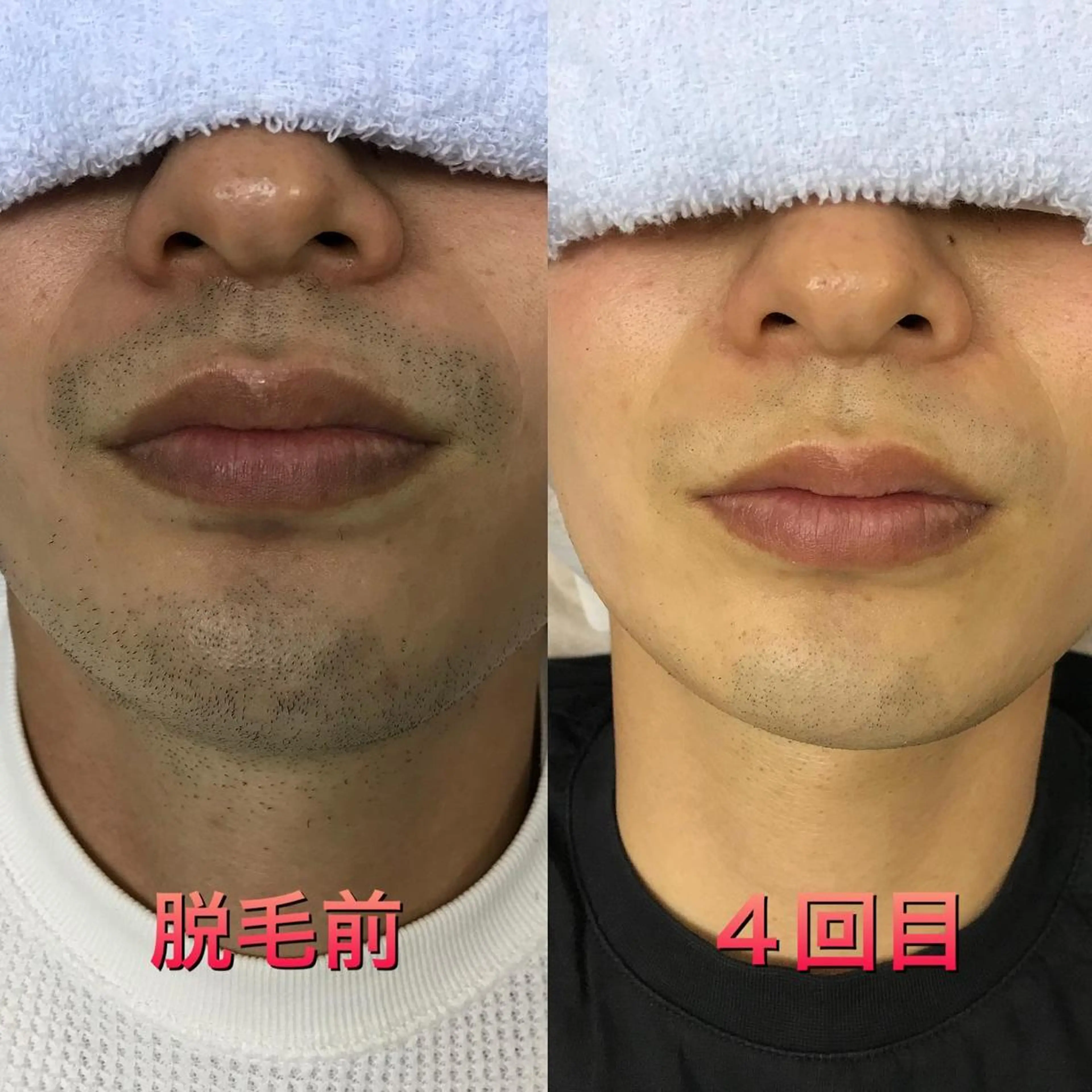 お試しメンズ脱毛　顔首全体脱毛の写真