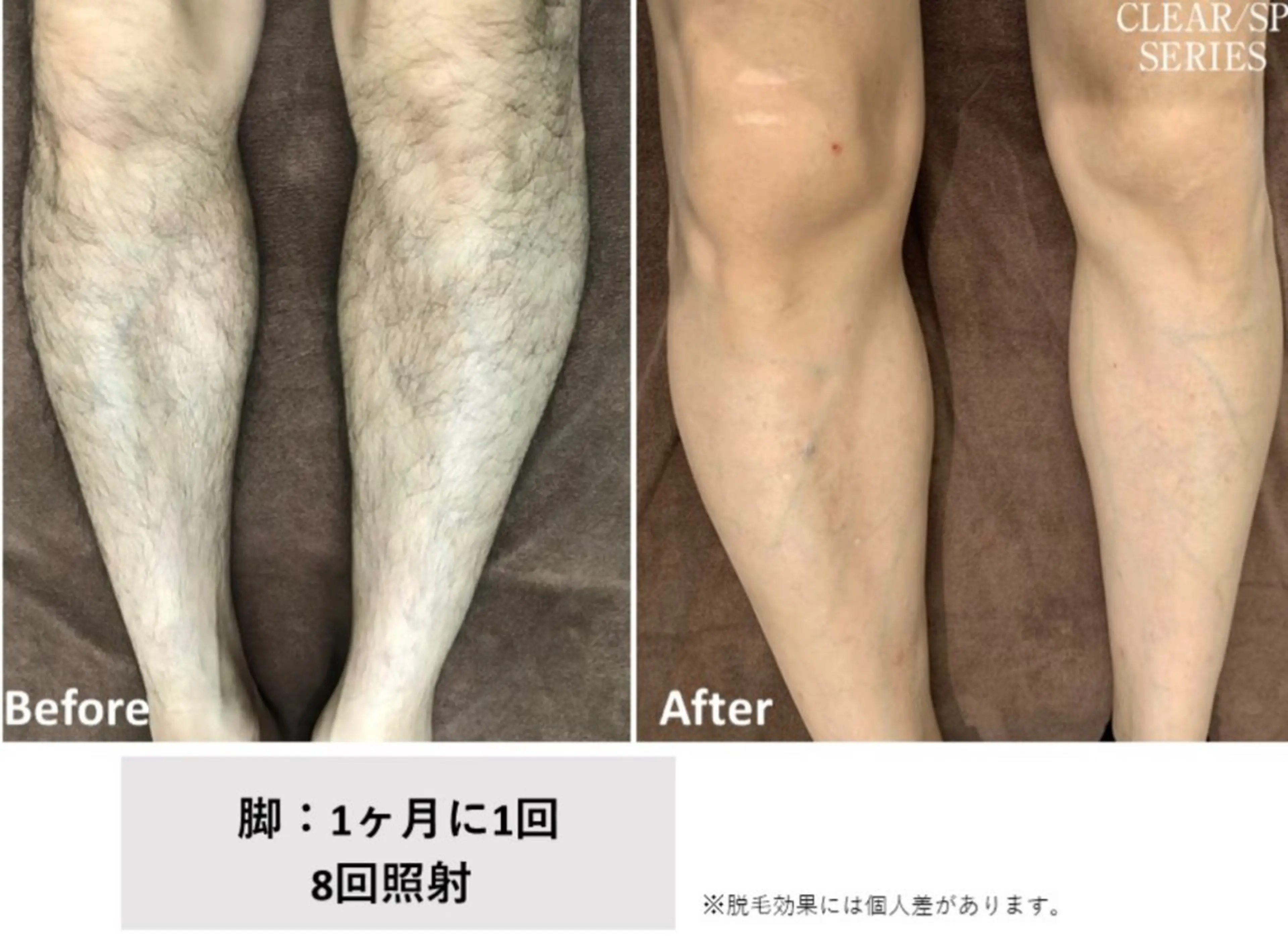 メンズ 足 全体脱毛✨の写真