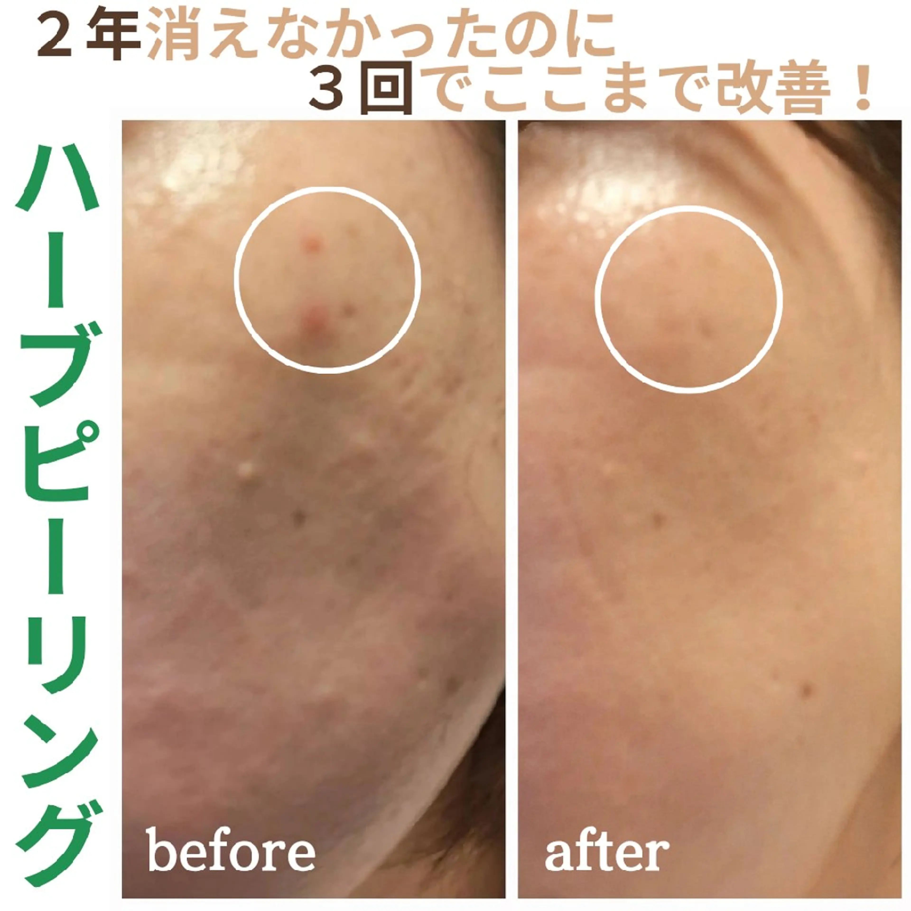 【ニキビ】剥離なしハーブピーリング+美容液導入　50分の写真