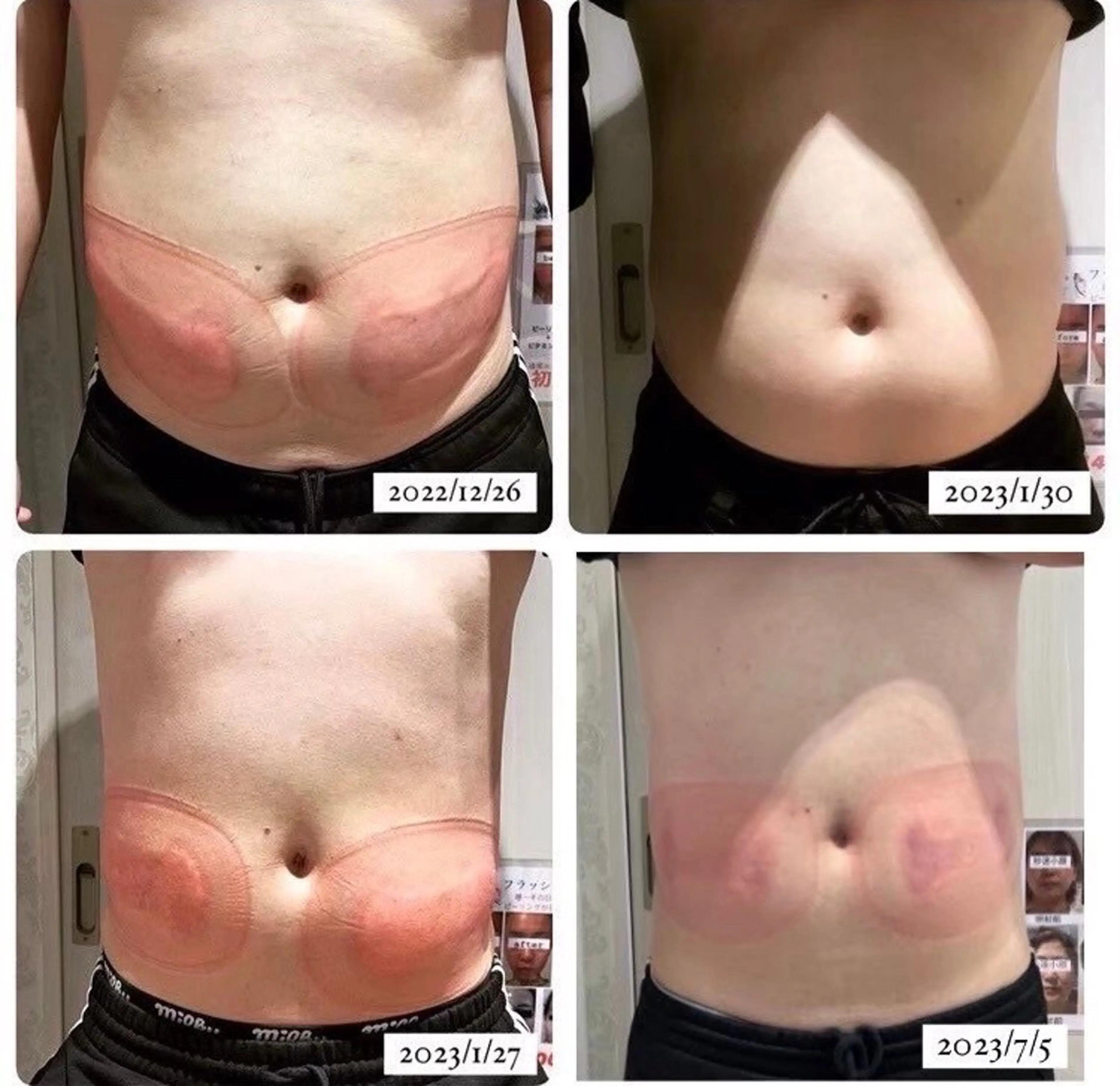 クールスカルプティングの写真