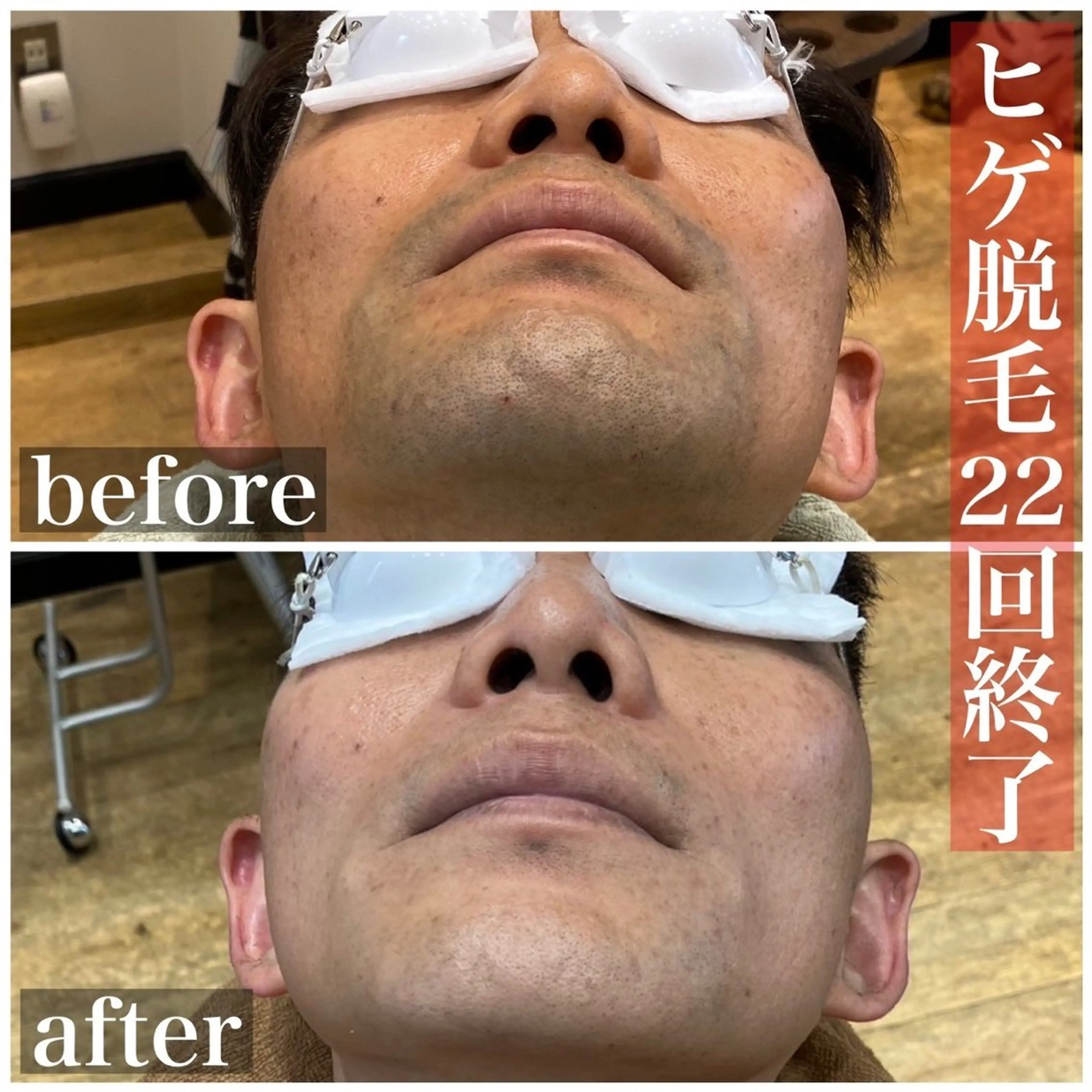 メンズ HAIRS YOSHIOKA所属・ヘアーズヨシオカ MENSヒゲ脱毛のエステ・リラクイメージ