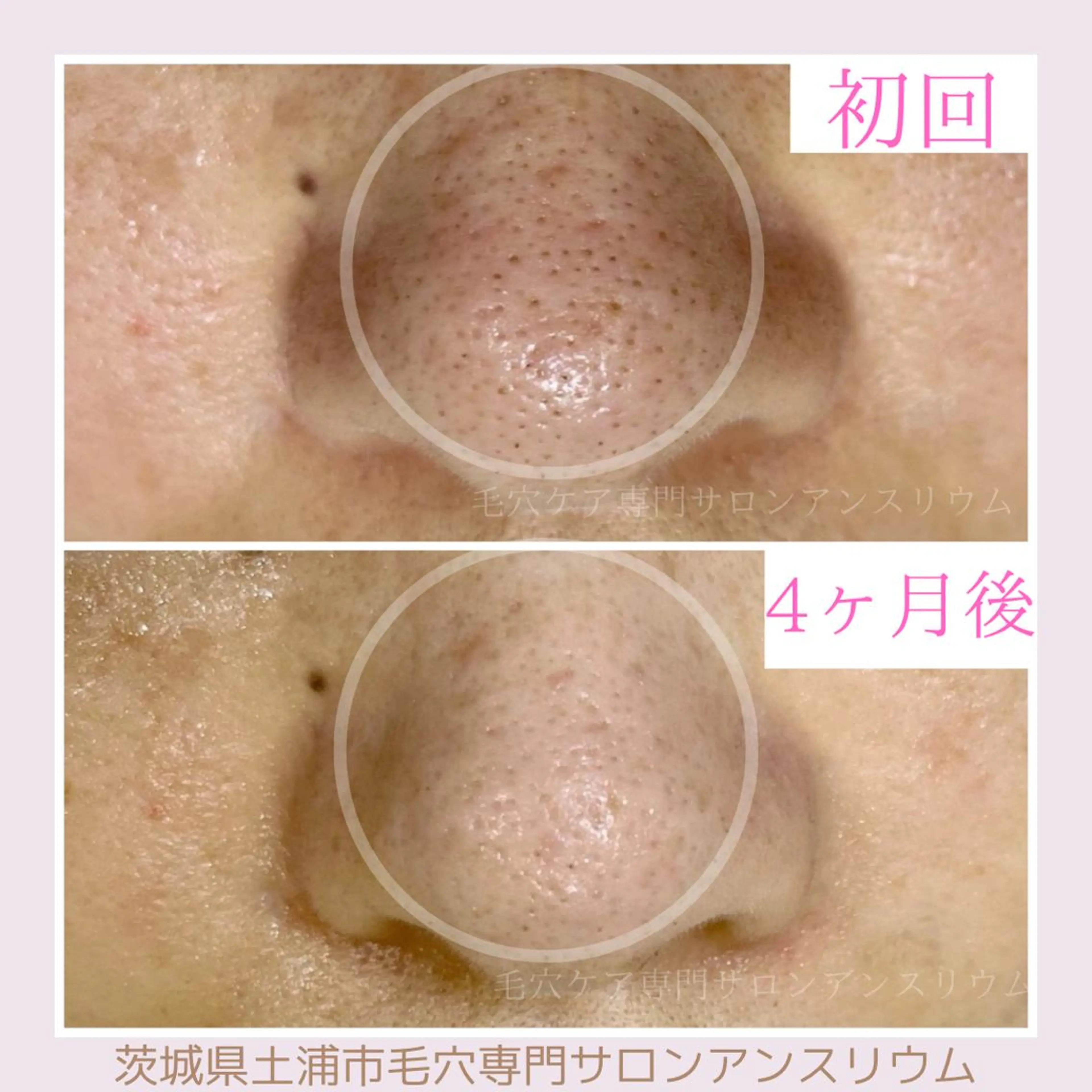 毛穴ケア専門サロンアンスリウム所属・茨城土浦 つくば毛穴 ケア専門サロンのエステ・リラクイメージ