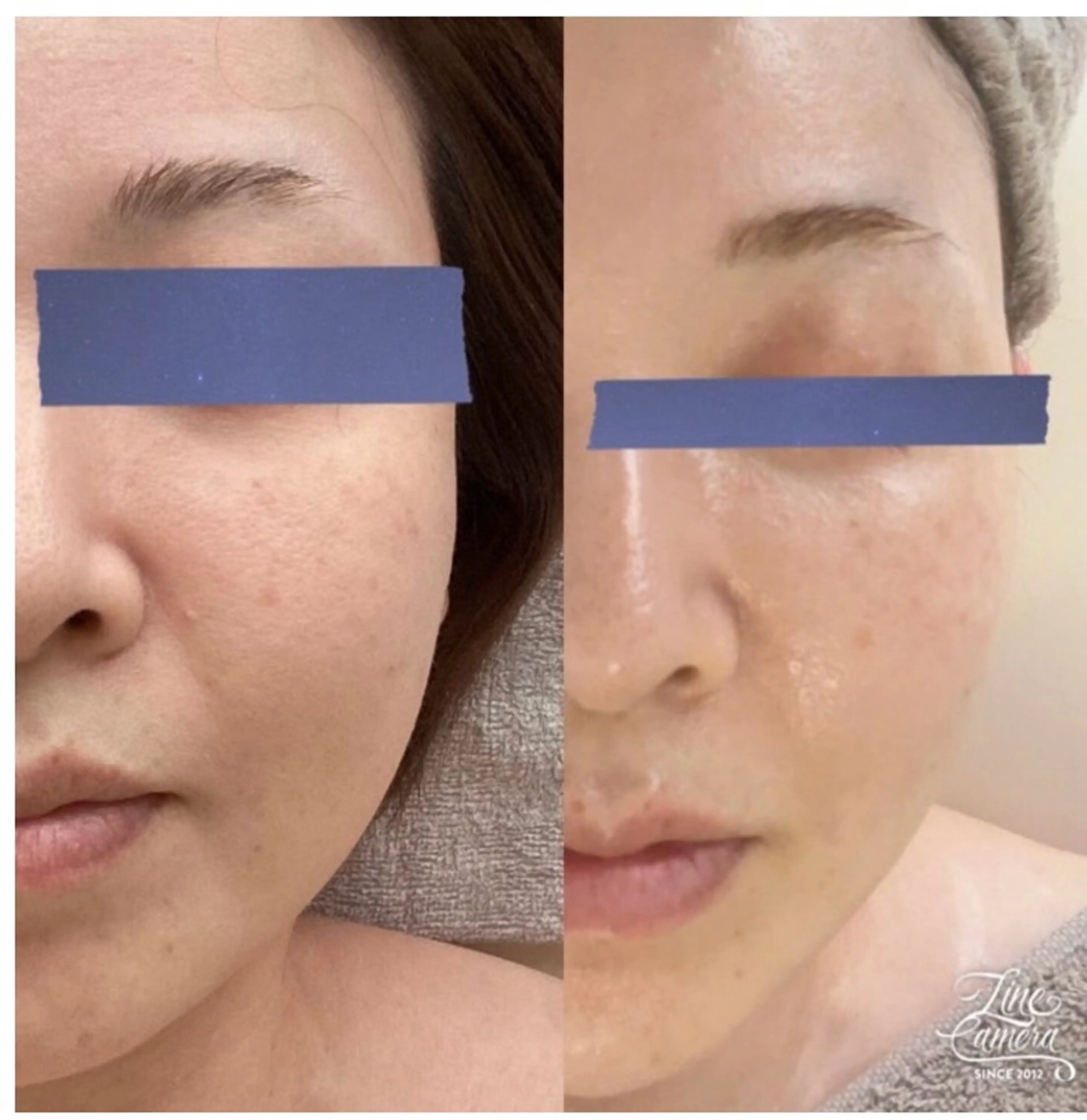 【しわ/たるみ改善★劇的変化✖️小顔リフトフェイシャル 75分】　40代以上のしわ、たるみが気になる方におすすめ♪の写真