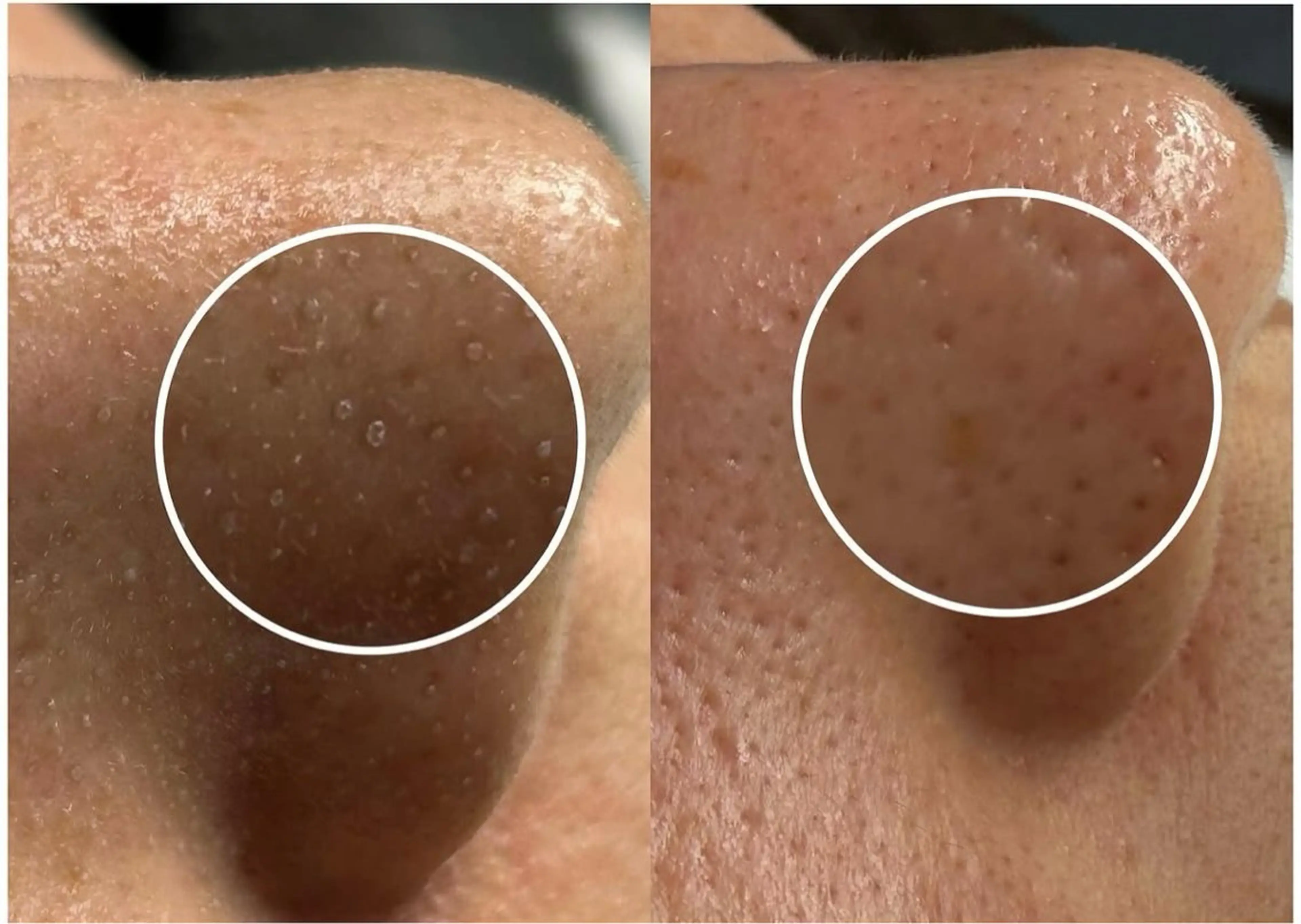 【2回目以降】😆黒ずみザラつき撃退コース❤️‍🔥の写真