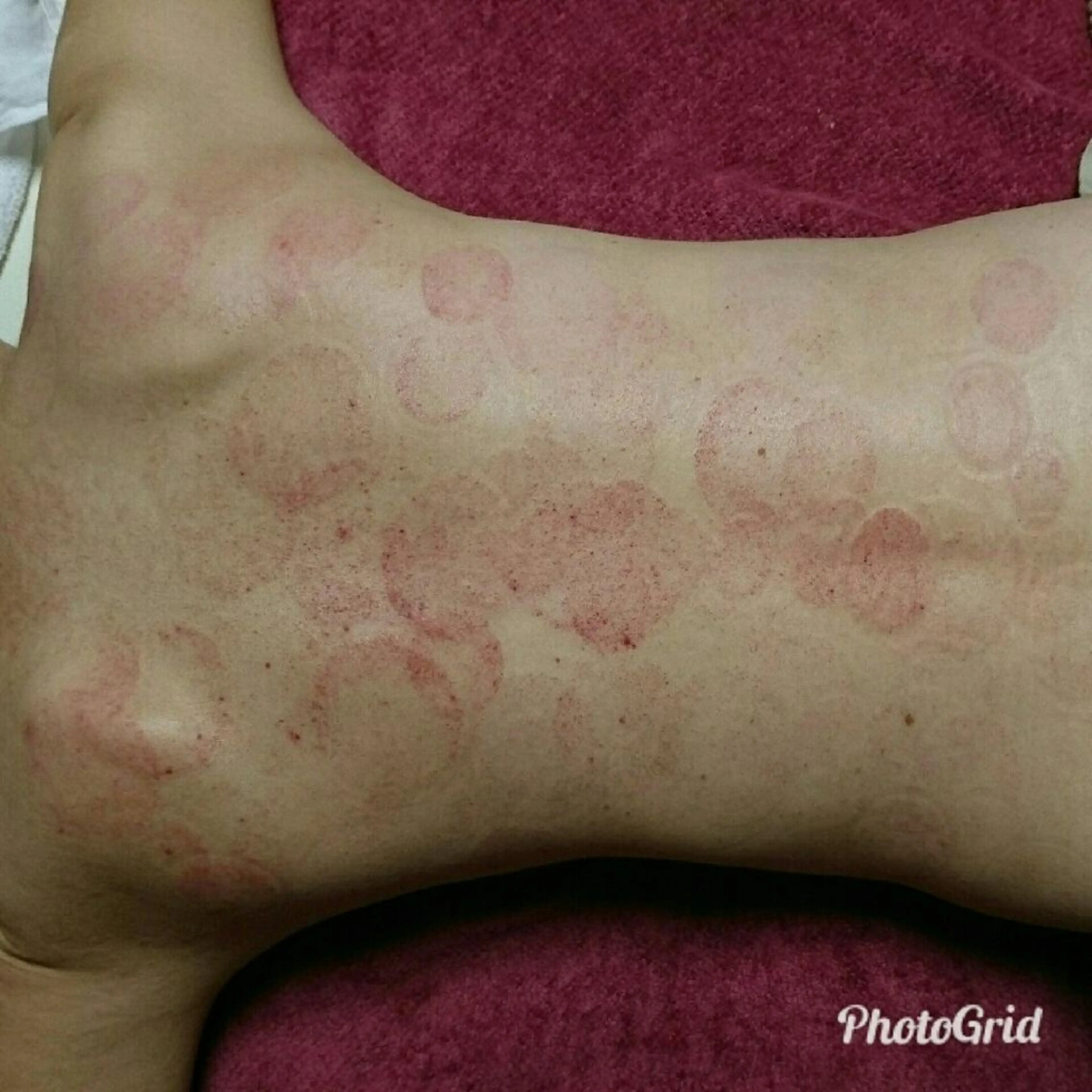 30分🕐️【凝りほぐし】カッピング✨肩こり・首こり・腰痛撃退コース✨の写真