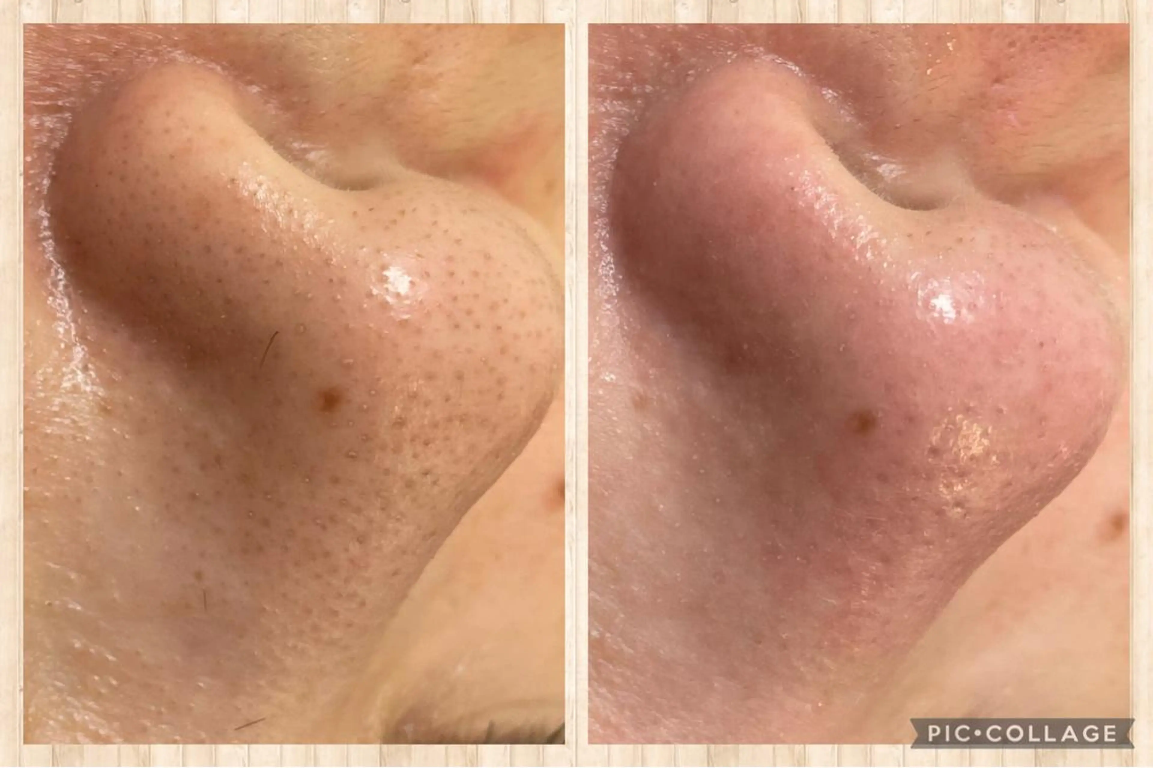 毛穴ｴｸｽﾄﾗｸｼｮﾝの写真