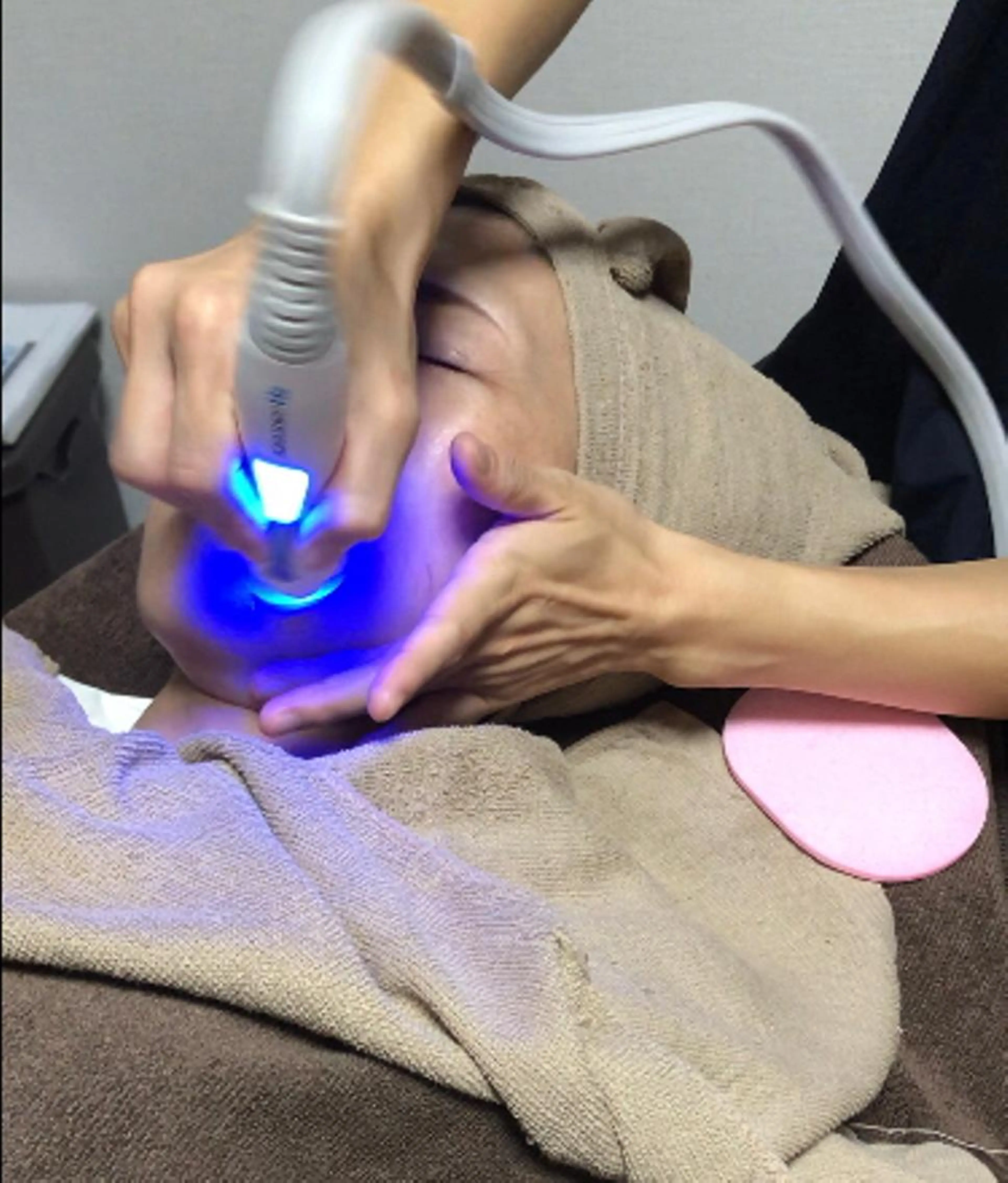 肌のザラつきを感じてる方　顔脱毛＋毛穴角質ケアの写真