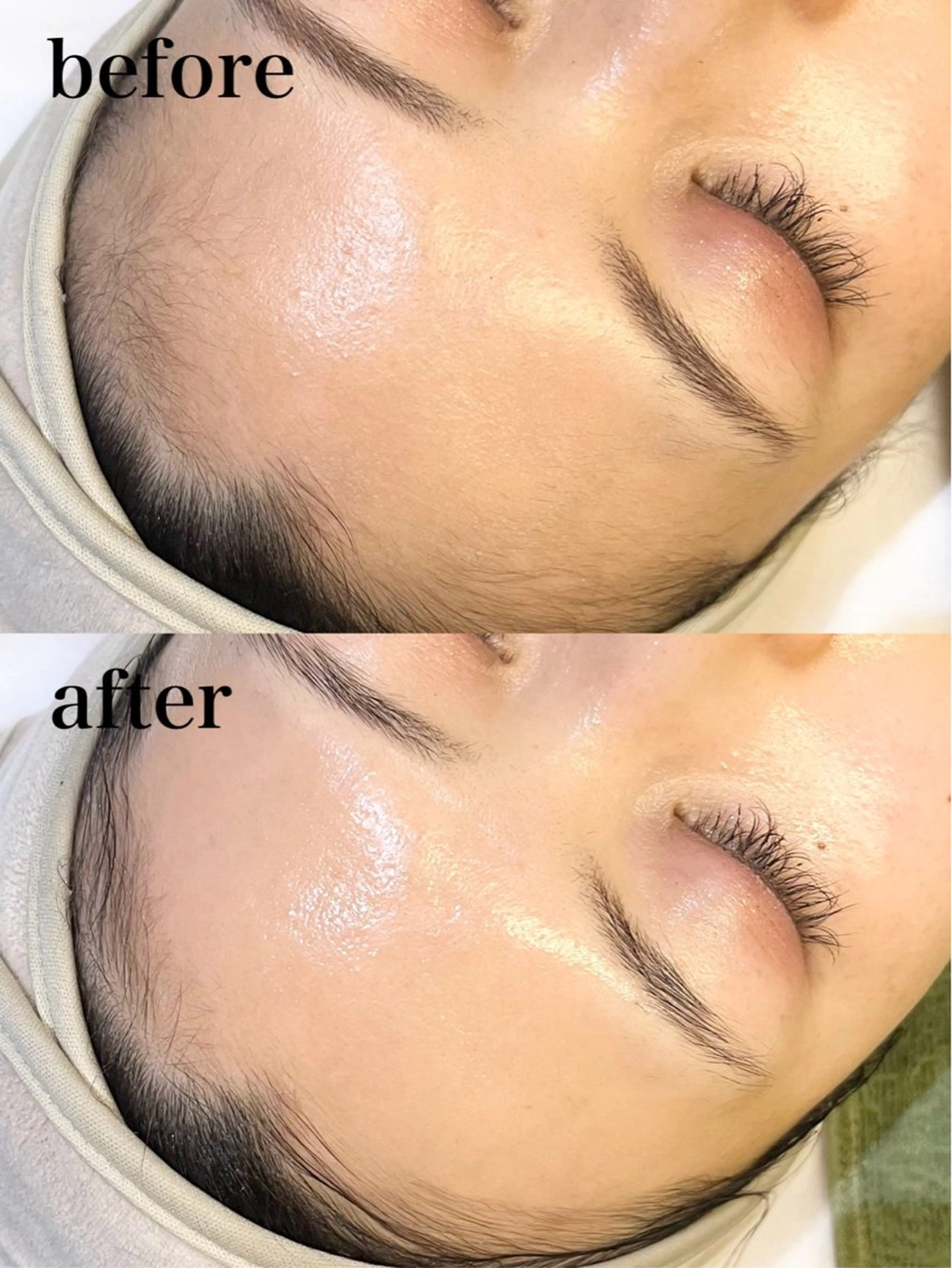 フェイシャルワックス（産毛脱毛）おでこ・ほほ・鼻・口周りから3パーツお選びいただけますの写真