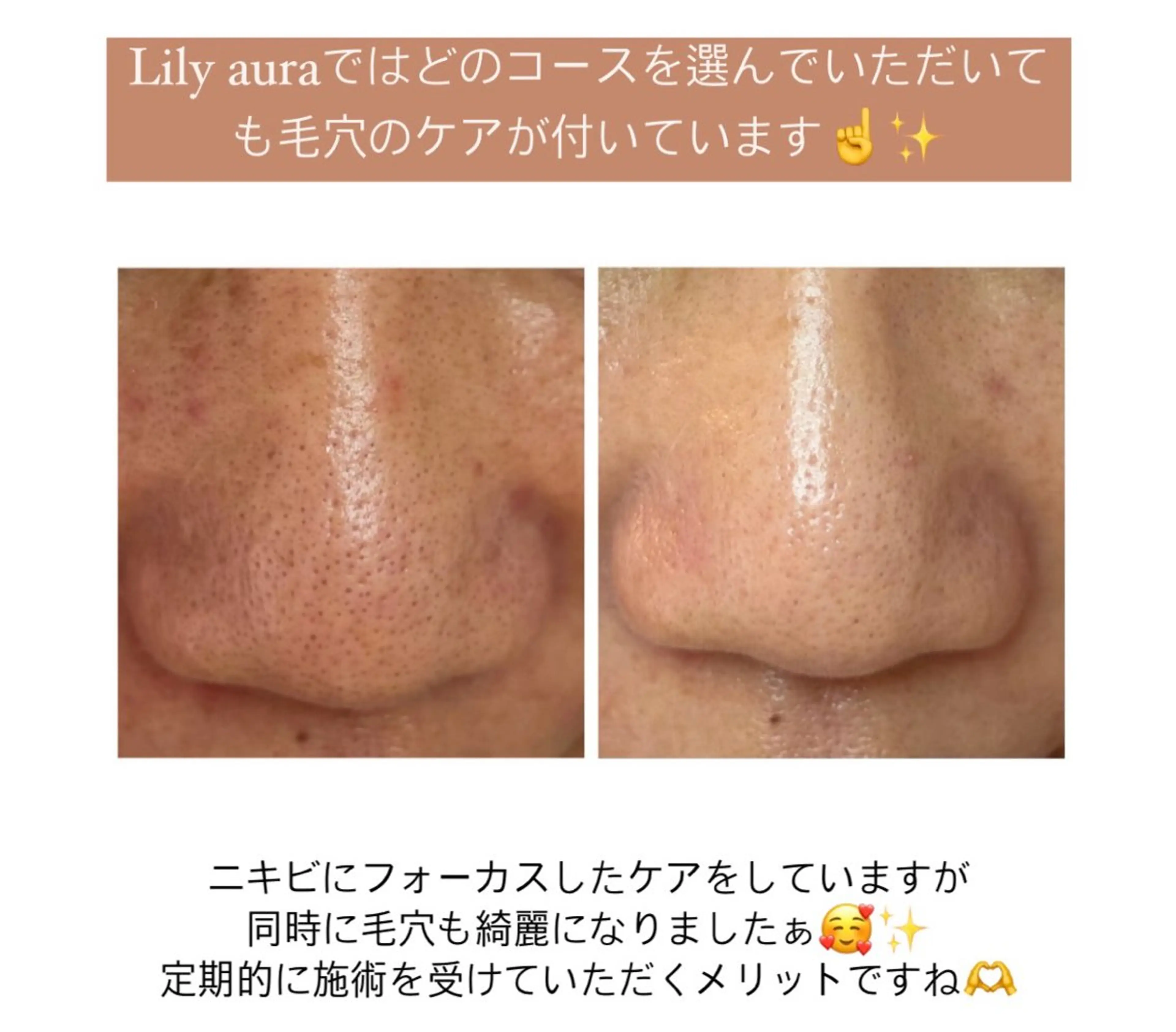 エステ ニキビ/敏感肌/乾燥 Lilyauraのエステ・リラクイメージ