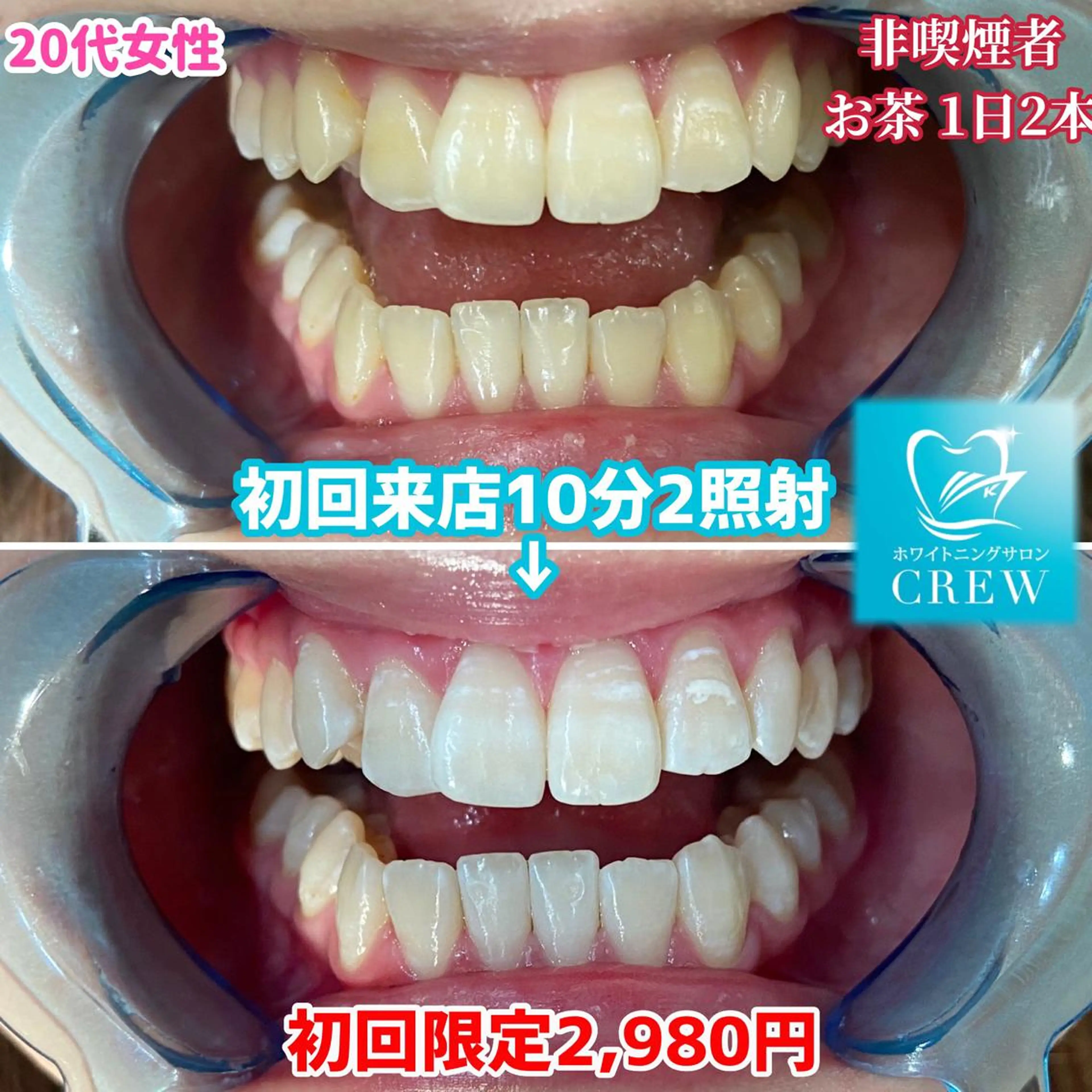 その他 ホワイトニング ⚓︎CREW柏⚓︎のその他イメージ
