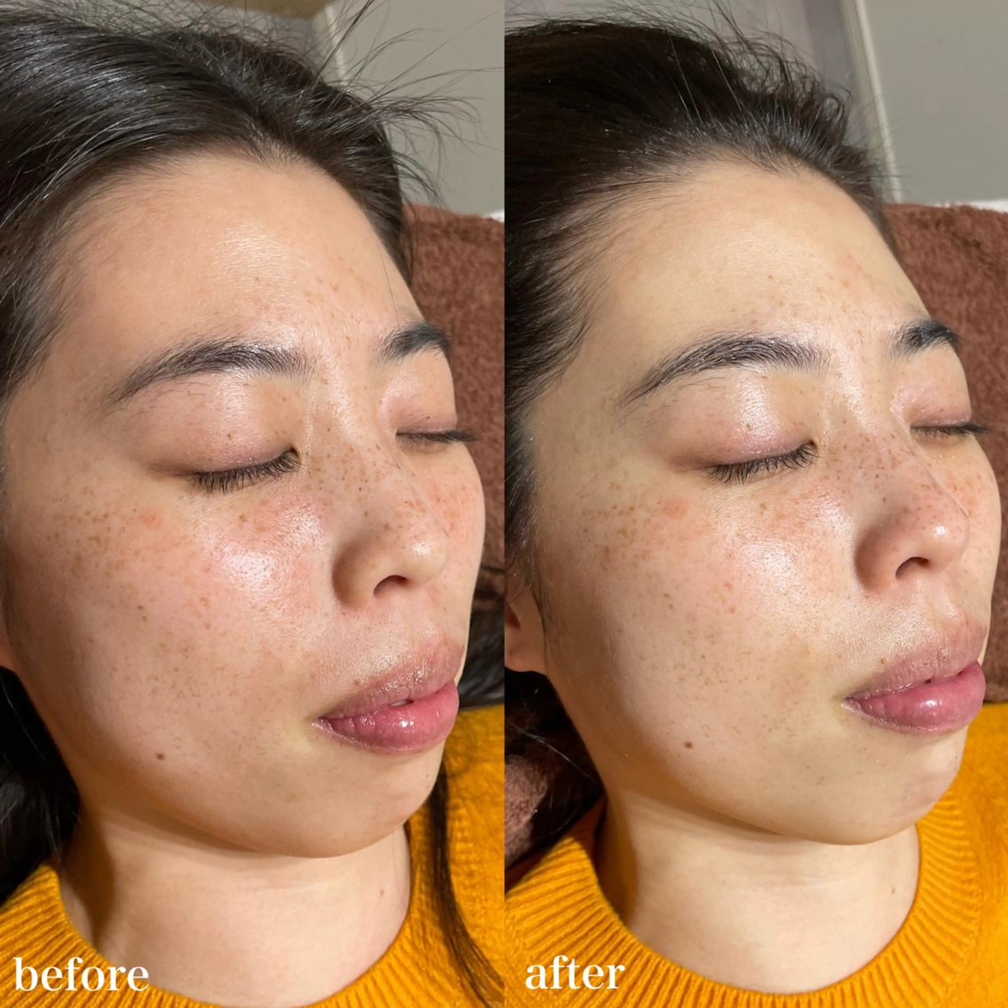 mieux所属・ハーブピーリング ¥6600のエステ・リラクイメージ