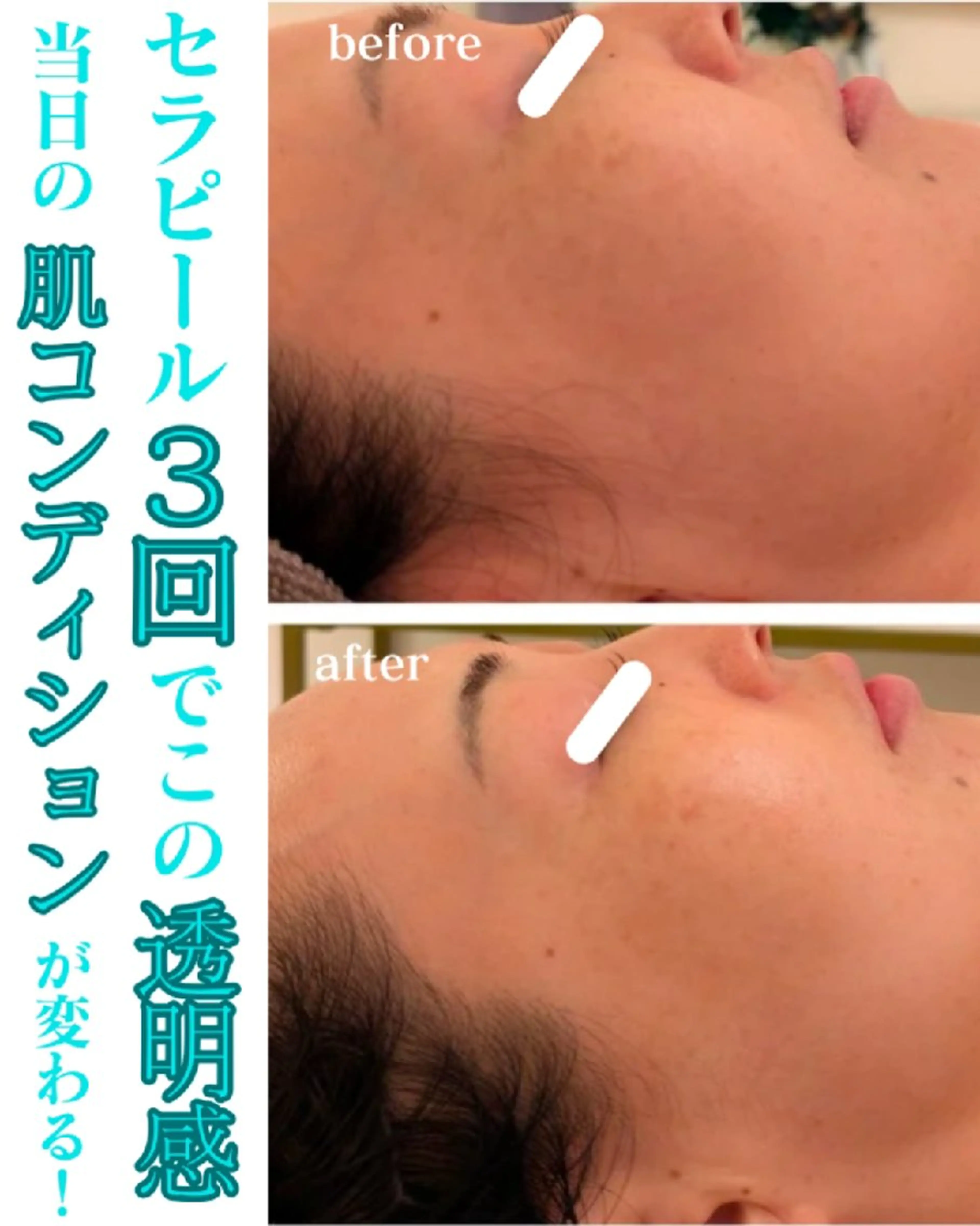 エステ リラク 毛穴ケア くすみ肌 ハーブピーリングのエステ・リラクイメージ