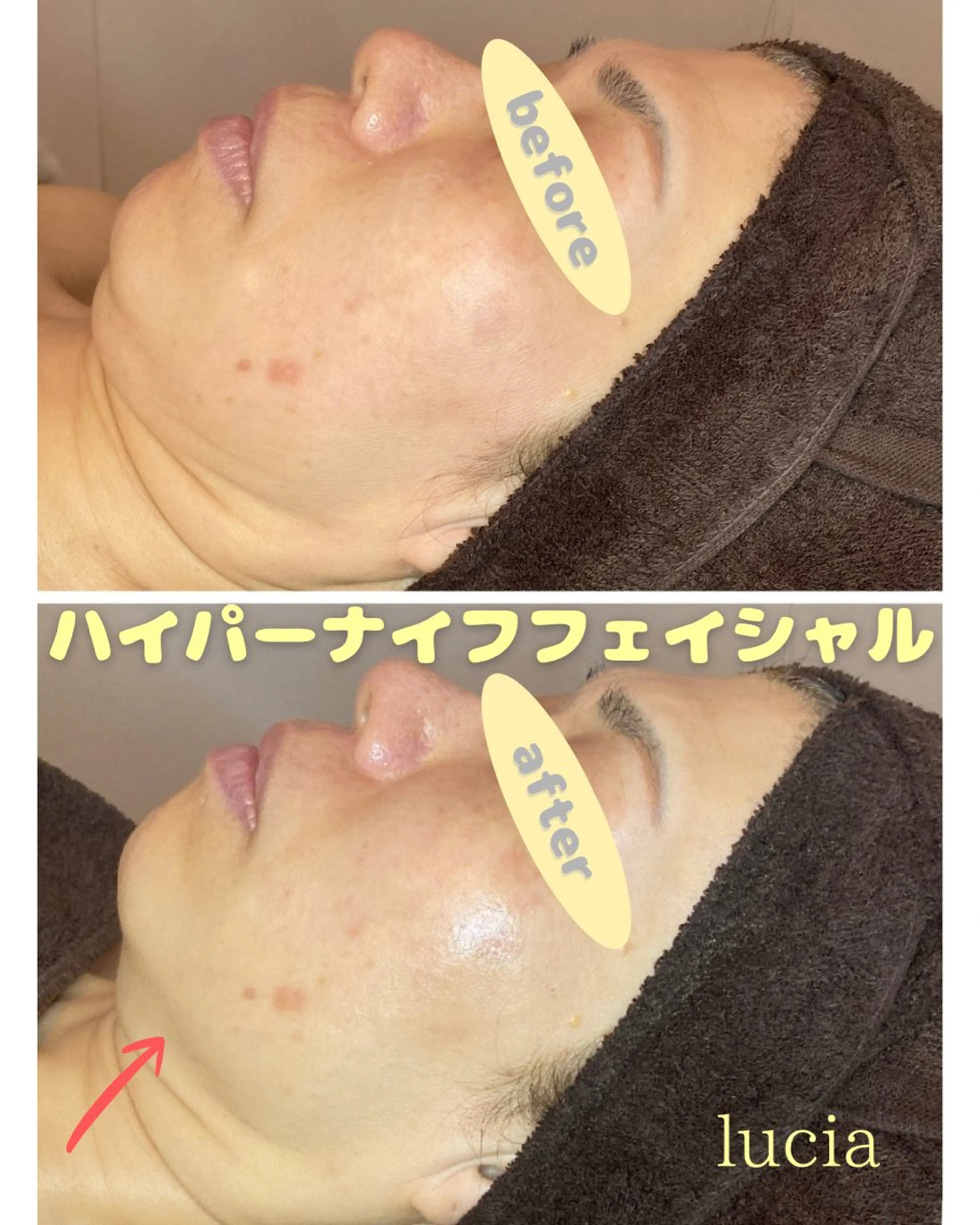 小顔体験✨ハイパーナイフフェイシャル💆‍♀️🫧50分の写真