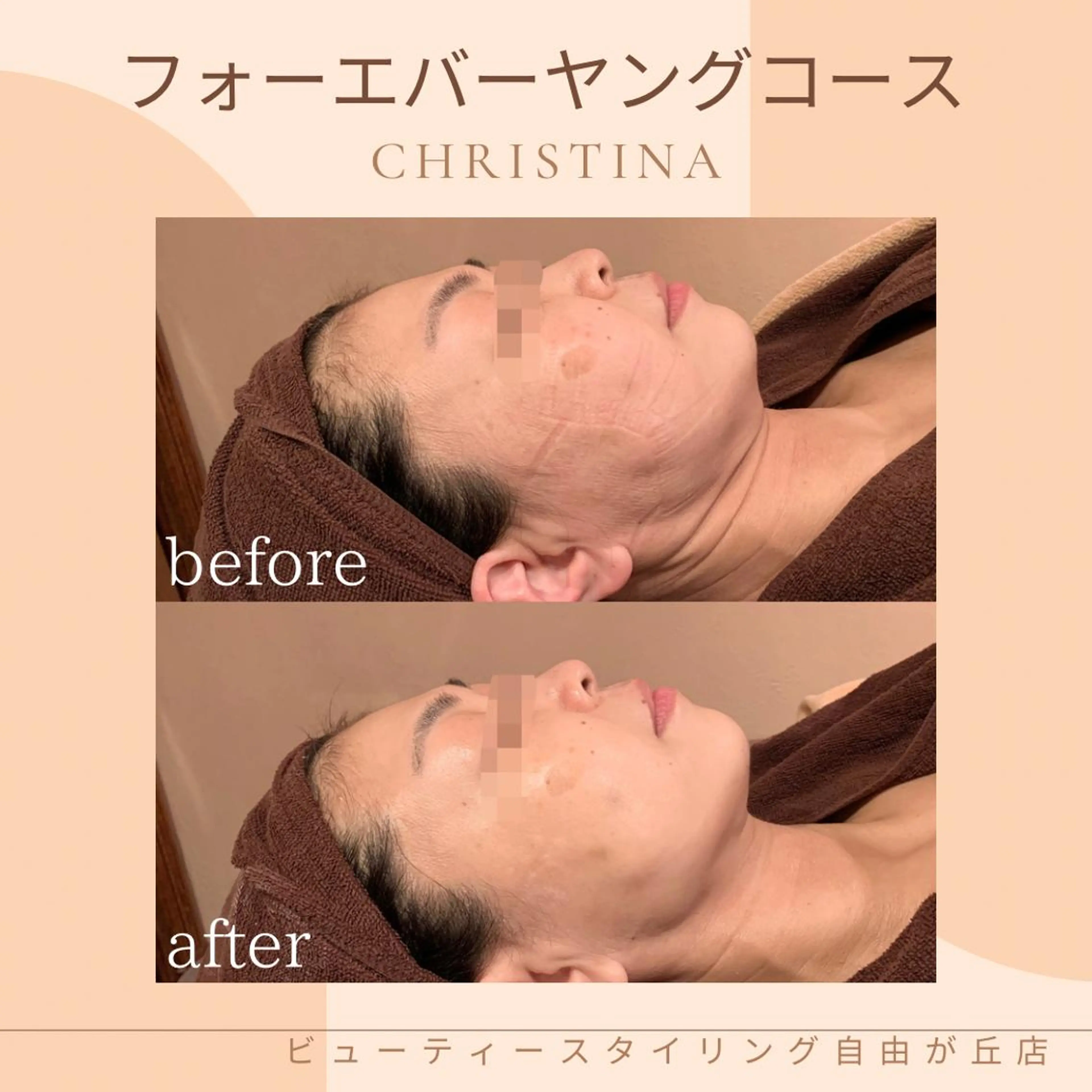 【クリスティーナ】フォーエバーヤング❣️小顔・リフトアップ🪞の写真