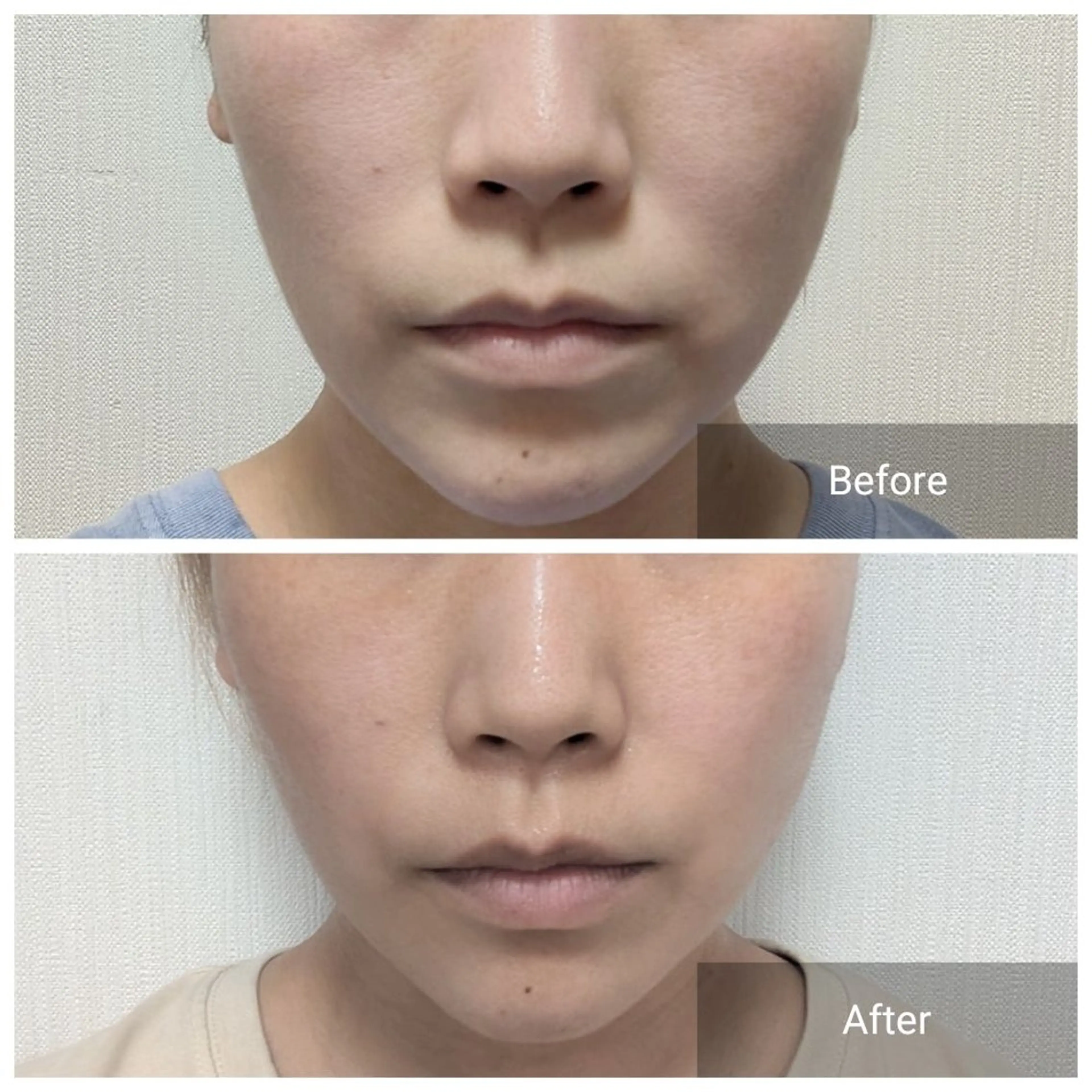 とにかくリフトアップしたい！フェイシャルリフトアップエイジングケア(エステティシャン施術)の写真