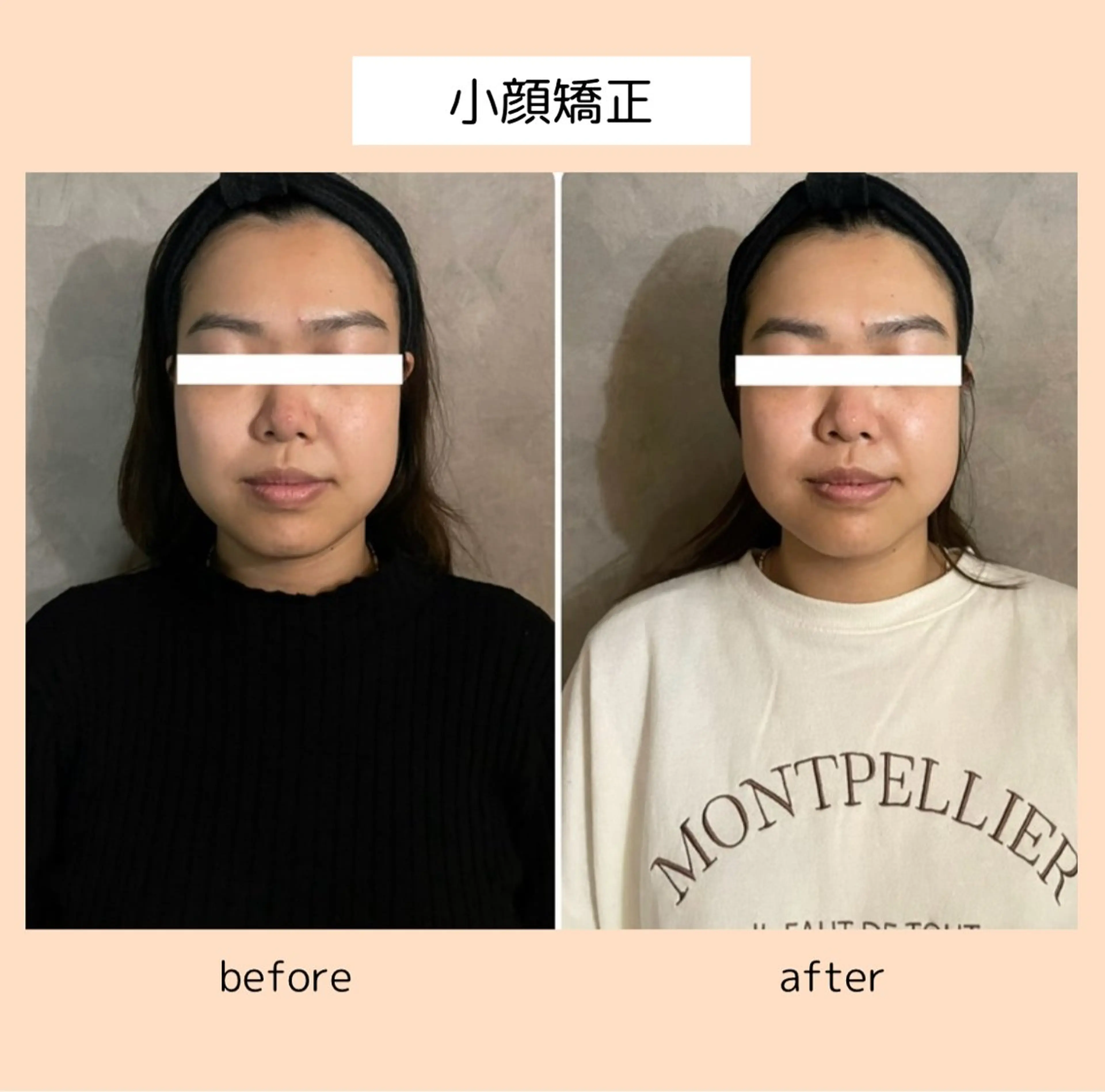 【小顔/リフトアップ/エラの張り/左右差/目の疲れ/たるみ】痛みのない💆♀️矯正美顔マッサージの写真