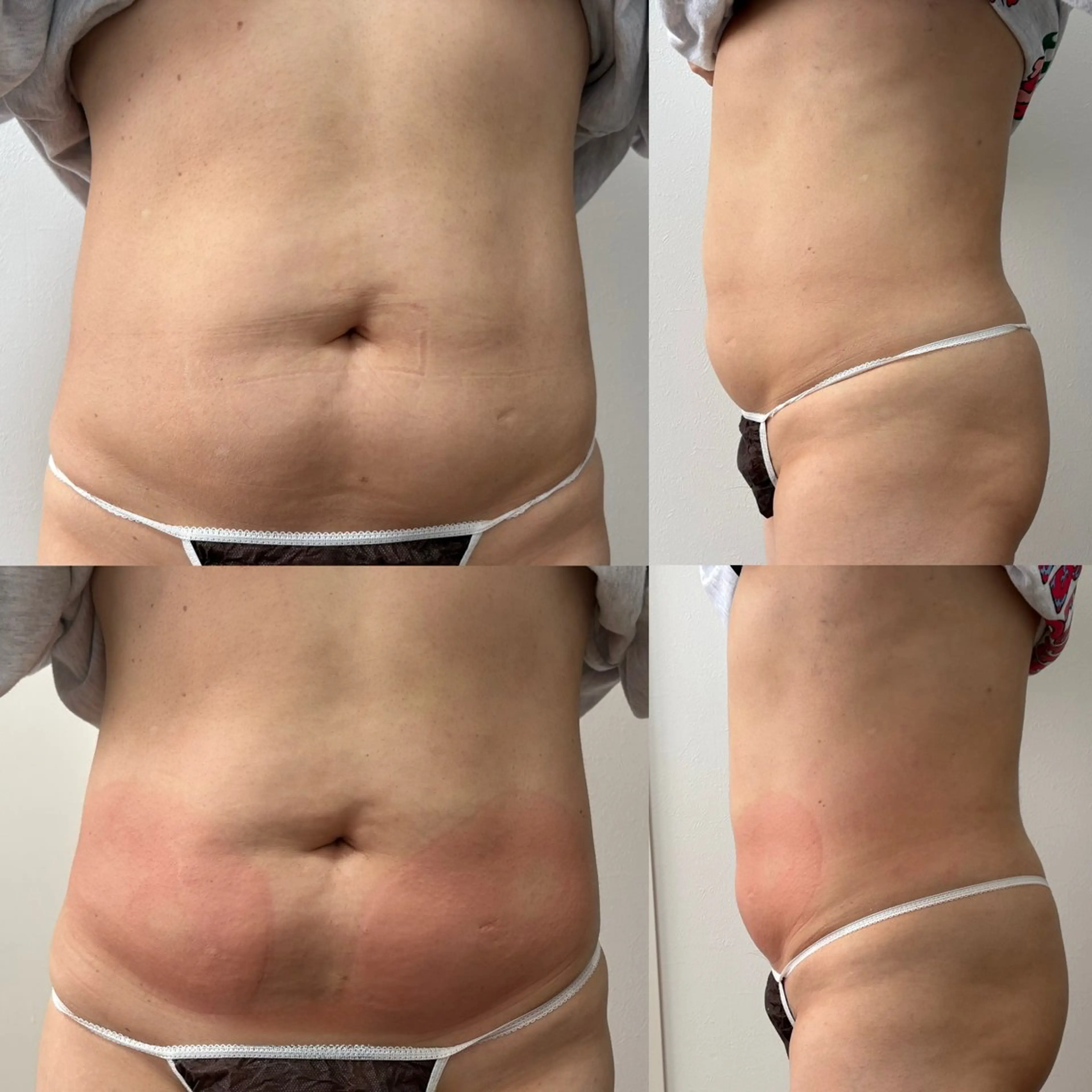 Miiju.所属・Miiju. 石巻市 脂肪冷却  鈴木のエステ・リラクイメージ