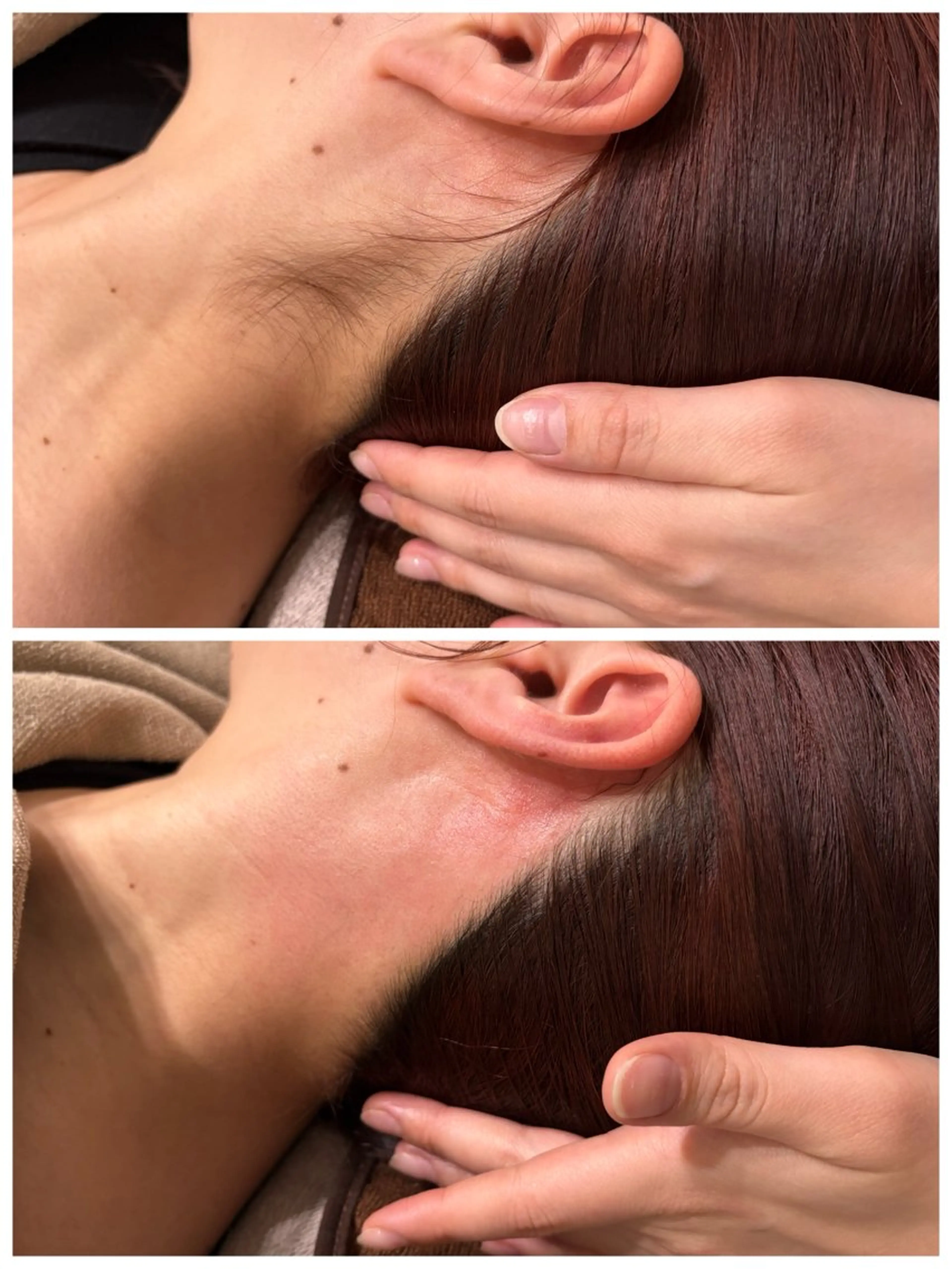 うなじWAX脱毛の写真