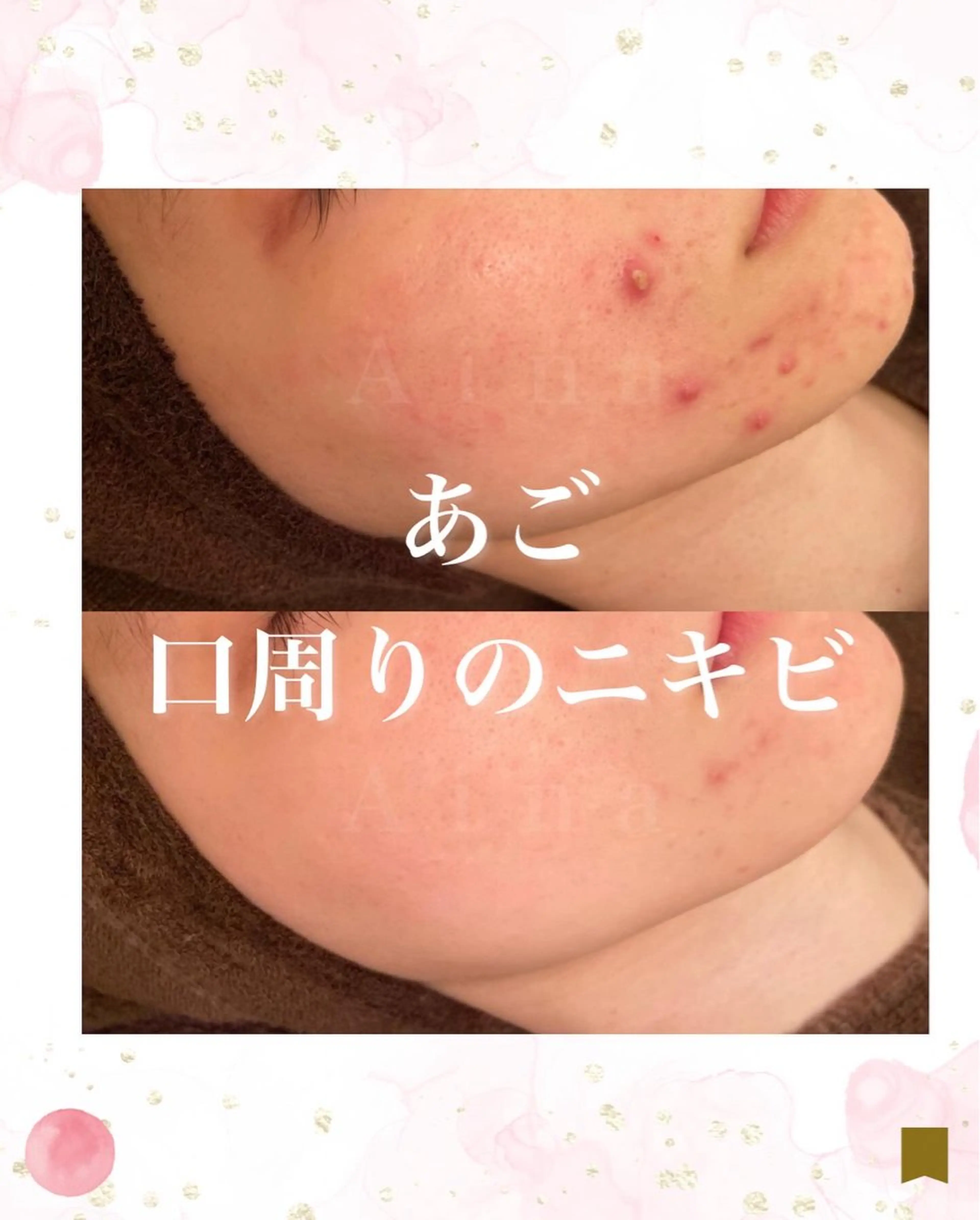 エステ リラク ニキビ跡専門サロン Ainaのエステ・リラクイメージ