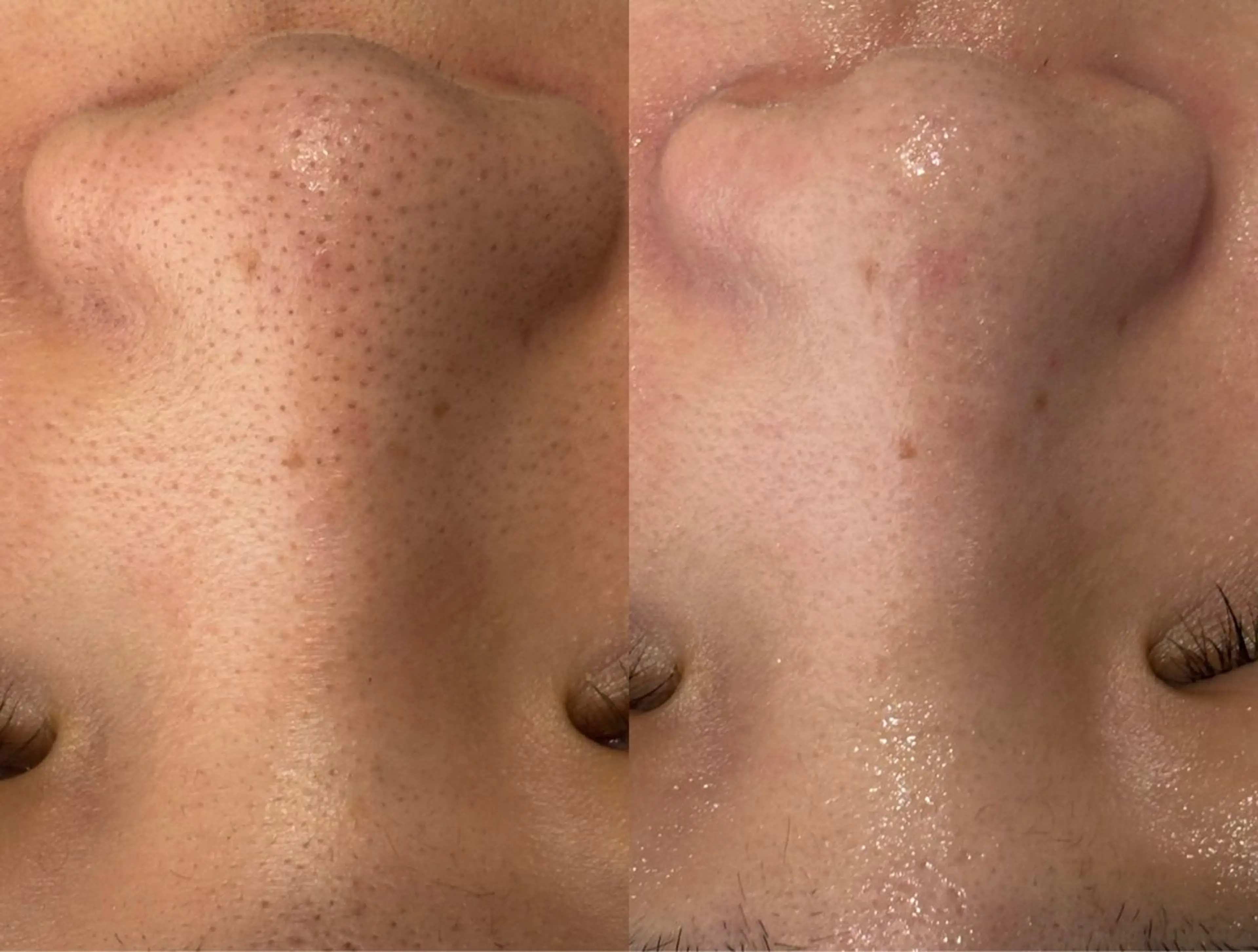 顔脱毛＋ハイドラ毛穴洗浄の写真