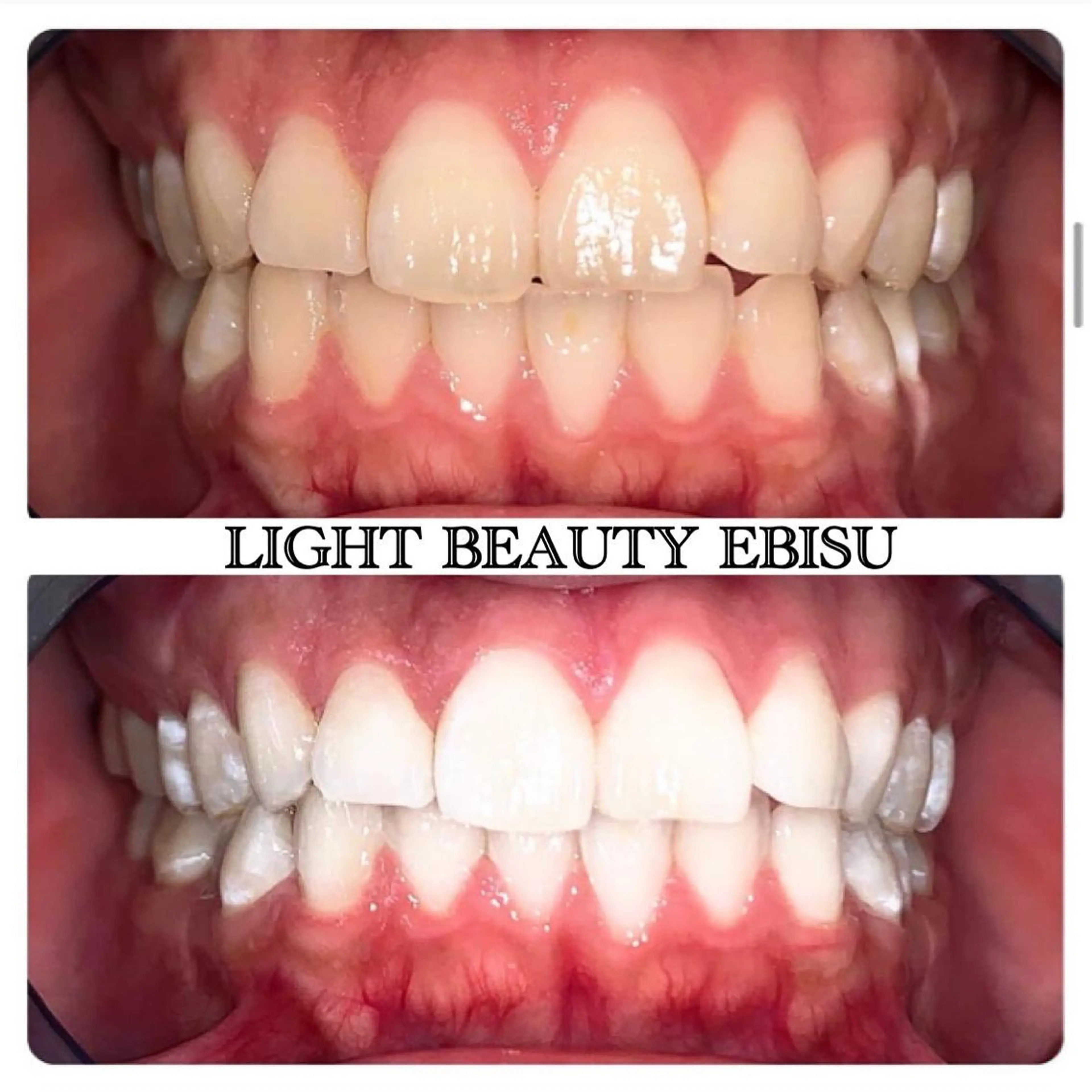 もっと激白ホワイトニング‼️圧倒的な白さ✨Wプレミアムホワイトニング✨〈合計110分3来店コース〉✨🦷✨の写真