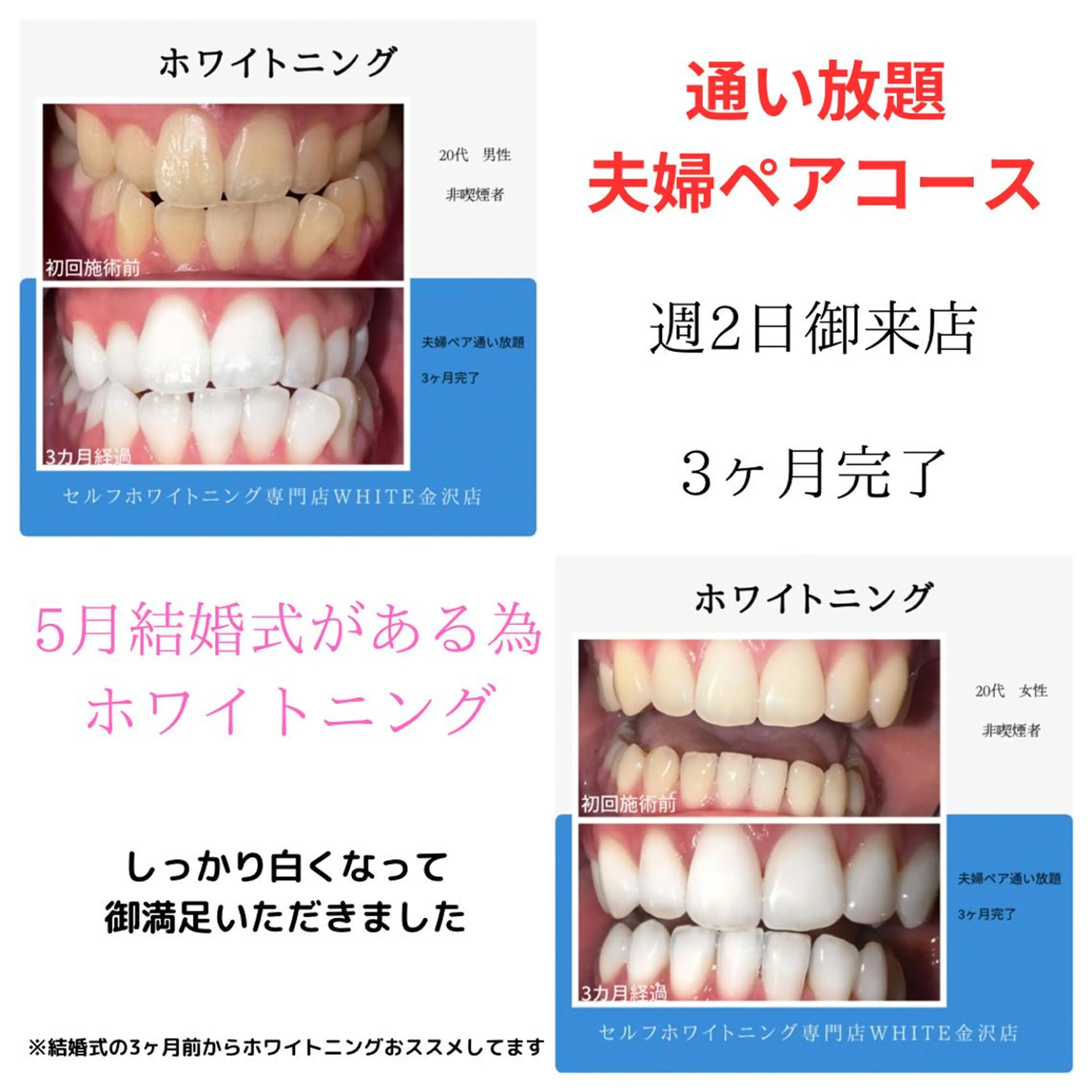 【イベント前に白く♪】セルフホワイトニング20分✖︎2.5回分セットの写真